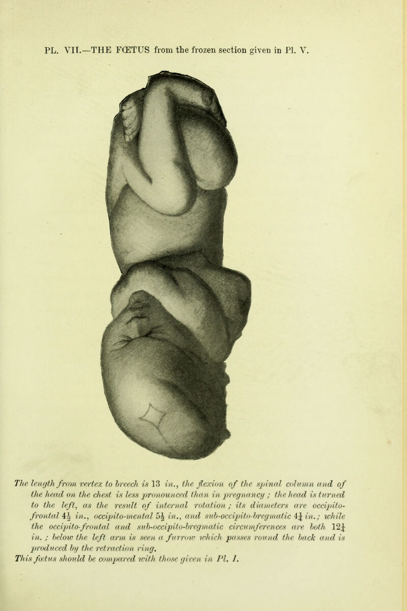 PL. VIT.—THE FCETUS from the frozen section given in PI. V. Tlic Iciujtli from vertex to breech is 13 iit., tJie flexiim of the sjiinol oilnniu and of the head on the chest is less proiiouitced than in jn'egnayicy ; the head is turned to the left, as the result of internal rotation ; its diameters are occipito- frontal ih, in., occijnto-mental 5^ in., and sub-occipito-bregmatic 4^ in.; tchile the occijnto-frontal and snb-occipito-bregmatic circumferences are both 12^ in. ; belotv the left arm is seen a furrow vhich passes round the back and is jrroduced by the retraction ring. This fat us should be comjtared tvith tJiose gicen in I'I. I.