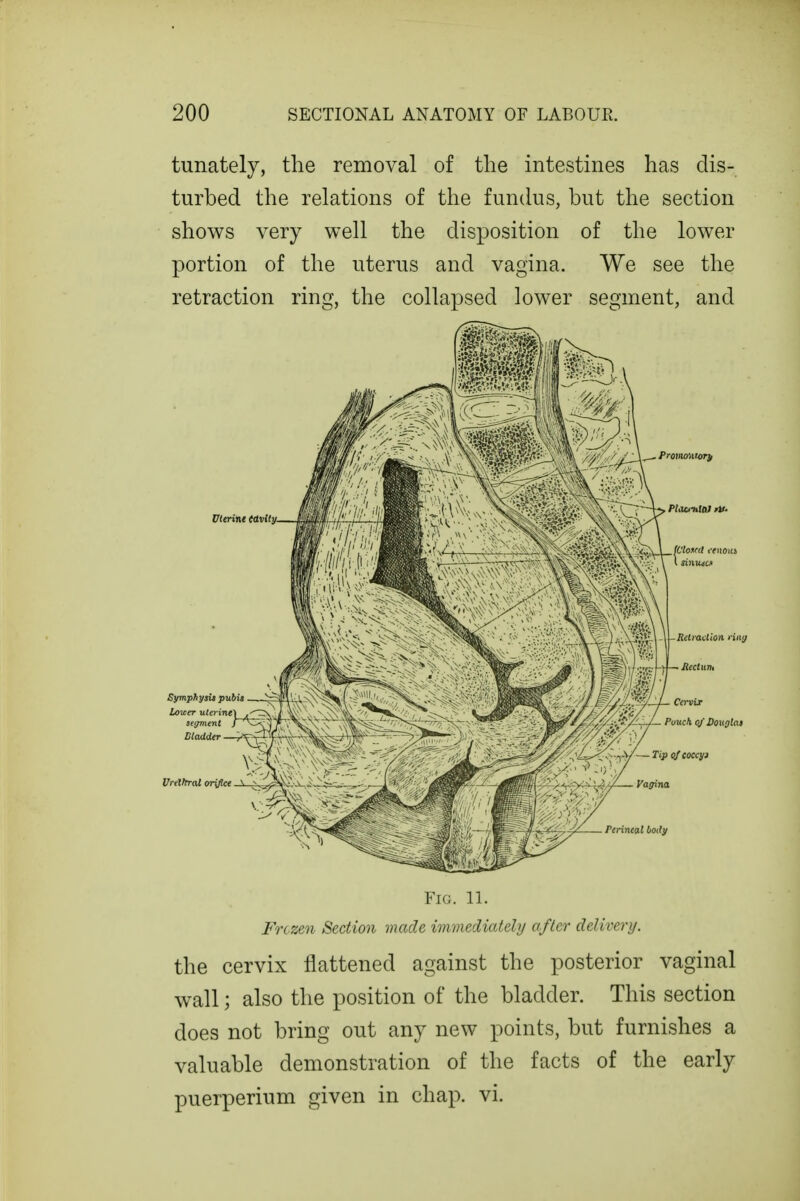 tunately, the removal of the intestines has dis- turbed the relations of the fundus, but the section shows very well the disposition of the lower portion of the uterus and vagina. We see the retraction ring, the collapsed lower segment, and Fig. 11. Frczen Section vmde immediately after delivery. the cervix flattened against the posterior vaginal wall; also the position of the bladder. This section does not bring out any new points, but furnishes a valuable demonstration of the facts of the early puerperium given in chap. vi.