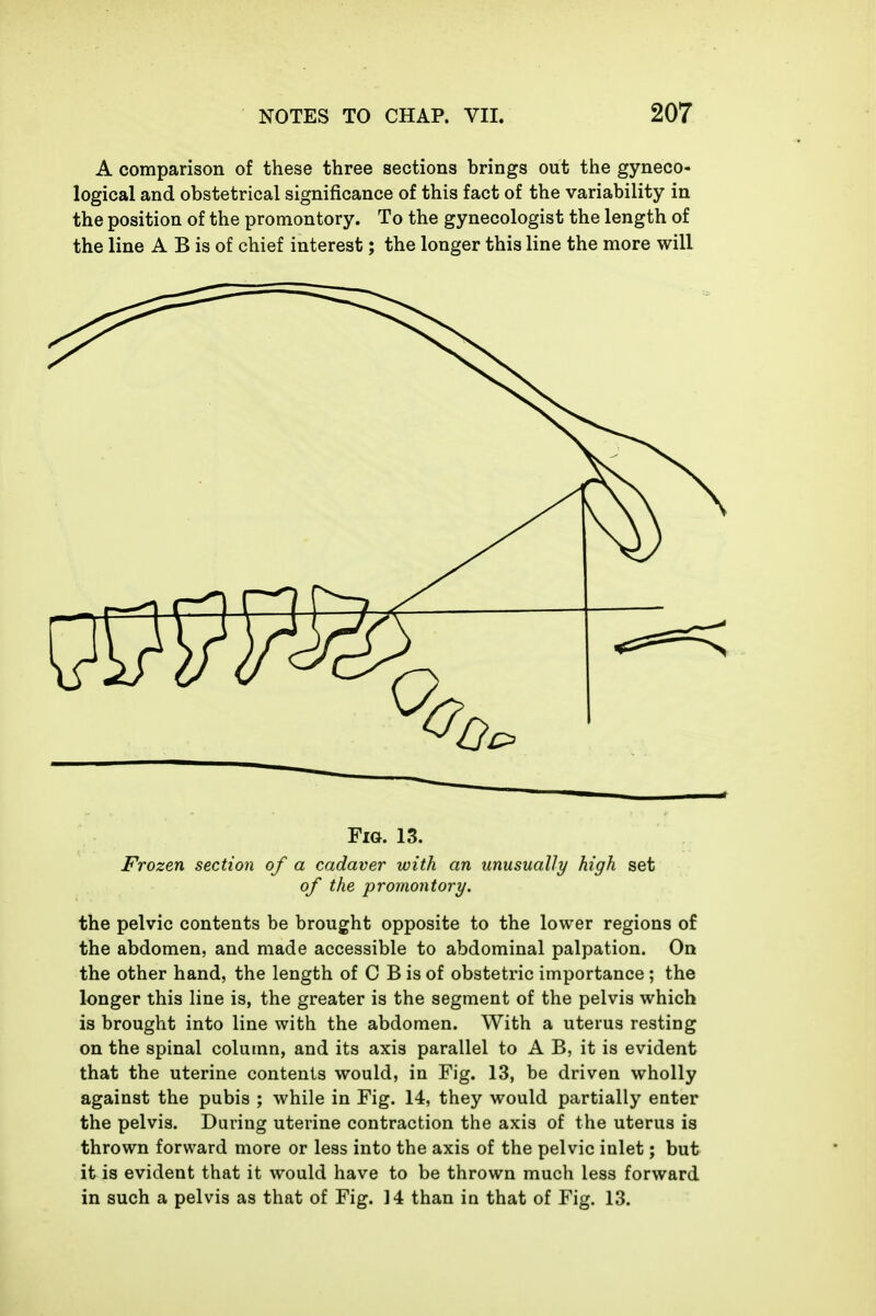 A comparison of these three sections brings out the gyneco- logical and obstetrical significance of this fact of the variability in the position of the promontory. To the gynecologist the length of the line A B is of chief interest; the longer this line the more will Fig. 13. Frozen section of a cadaver with an unusually high set of the promontory. the pelvic contents be brought opposite to the lower regions of the abdomen, and made accessible to abdominal palpation. On the other hand, the length of 0 B is of obstetric importance ; the longer this line is, the greater is the segment of the pelvis which is brought into line with the abdomen. With a uterus resting on the spinal column, and its axis parallel to A B, it is evident that the uterine contents would, in Fig. 13, be driven wholly against the pubis ; while in Fig. 14, they would partially enter the pelvis. During uterine contraction the axis of the uterus is thrown forward more or less into the axis of the pelvic inlet; but it is evident that it would have to be thrown much less forward in such a pelvis as that of Fig. 14 than in that of Fig. 13.