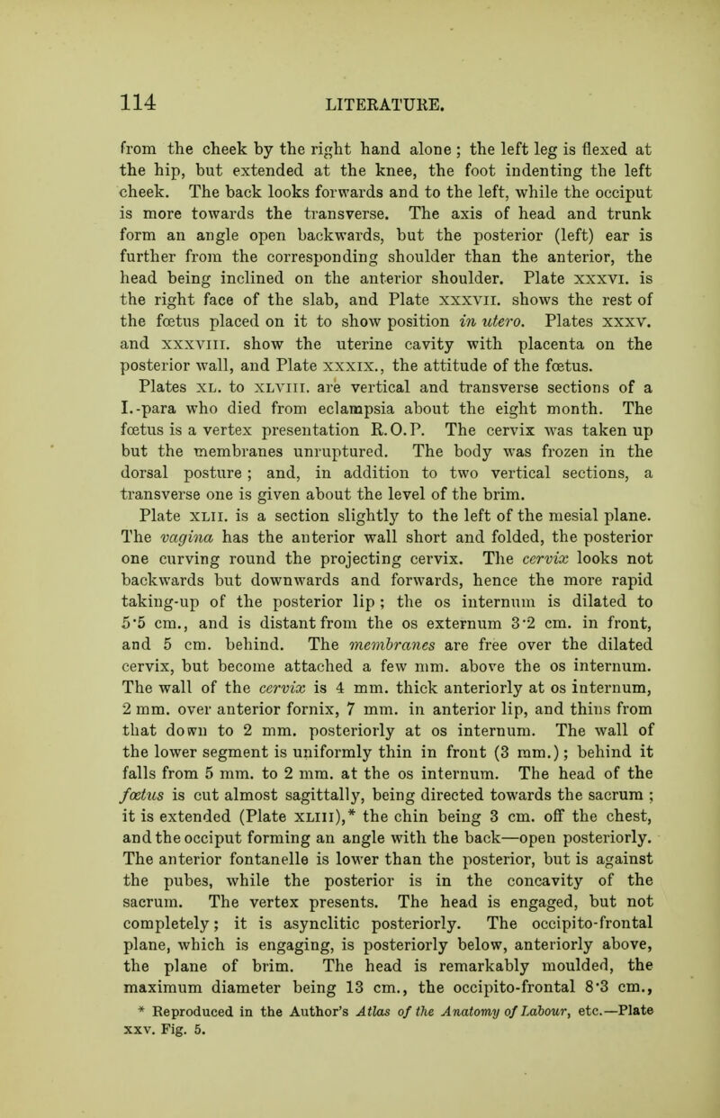 from the cheek by the right hand alone ; the left leg is flexed at the hip, but extended at the knee, the foot indenting the left cheek. The back looks forwards and to the left, while the occiput is more towards the transverse. The axis of head and trunk form an angle open backwards, but the posterior (left) ear is further from the corresponding shoulder than the anterior, the head being inclined on the anterior shoulder. Plate xxxvi. is the right face of the slab, and Plate xxxvii. shows the rest of the foetus placed on it to show position in utero. Plates xxxv. and XXXVIII. show the uterine cavity with placenta on the posterior wall, and Plate xxxix., the attitude of the foetus. Plates XL. to XLViii. are vertical and transverse sections of a I.-para who died from eclampsia about the eight month. The foetus is a vertex presentation R.O.P. The cervix was taken up but the membranes unruptured. The body was frozen in the dorsal posture ; and, in addition to two vertical sections, a transverse one is given about the level of the brim. Plate XLii. is a section slightly to the left of the mesial plane. The vagina has the anterior wall short and folded, the posterior one curving round the projecting cervix. The cervix looks not backwards but downwards and forwards, hence the more rapid taking-up of the posterior lip ; the os internum is dilated to 5*5 cm., and is distant from the os externum 3*2 cm. in front, and 5 cm. behind. The membranes are free over the dilated cervix, but become attached a few mm. above the os internum. The wall of the cervix is 4 mm. thick anteriorly at os internum, 2 mm. over anterior fornix, 7 mm. in anterior lip, and thins from that dosvn to 2 mm. posteriorly at os internum. The wall of the lower segment is uniformly thin in front (3 ram.); behind it falls from 5 mm. to 2 mm. at the os internum. The head of the foetus is cut almost sagittally, being directed towards the sacrum ; it is extended (Plate xliii),* the chin being 3 cm. off the chest, and the occiput forming an angle with the back—open posteriorly. The anterior fontanelle is lower than the posterior, but is against the pubes, while the posterior is in the concavity of the sacrum. The vertex presents. The head is engaged, but not completely; it is asynclitic posteriorly. The occipito-frontal plane, which is engaging, is posteriorly below, anteriorly above, the plane of brim. The head is remarkably moulded, the maximum diameter being 13 cm., the occipito-frontal 8*3 cm., * Reproduced in the Author's Atlas of the Anatomy of Labour, etc.—Plate XXV. Fig. 5.