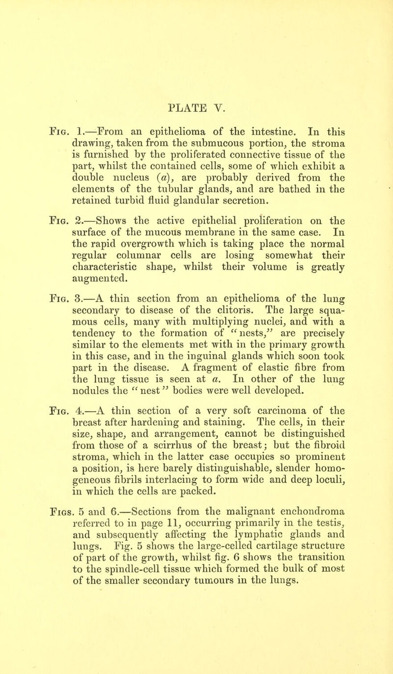 Fig. 1.—From an epithelioma of the intestine. In this drawing, taken from the submucous portion, the stroma is furnished by the proliferated connective tissue of the part, whilst the contained cells, some of which exhibit a double nucleus («), are probably derived from the elements of the tubular glands, and are bathed in the retained turbid fluid glandular secretion. Fig. 2.—Shows the active epithelial proliferation on the surface of the mucous membrane in the same case. In the rapid overgrowth which is taking place the normal regular columnar cells are losing somewhat their characteristic shape^ whilst their volume is greatly augmented. Fig. 3.—A thin section from an epithelioma of the long secondary to disease of the clitoris. The large squa- mous cells, many with multiplying nuclei, and with a tendency to the formation of nests,^^ are precisely similar to the elements met with in the primary growth in this case, and in the inguinal glands which soon took part in the disease. A fragment of elastic fibre from the lung tissue is seen at a. In other of the lung nodules the ^' nestbodies were well developed. Fig. 4.—A thin section of a very soft carcinoma of the breast after hardening and staining. The cells, in their size, shape, and arrangement, cannot be distinguished from those of a scirrhus of the breast; but the fibroid stroma, which in the latter case occupies so prominent a position, is here barely distinguishable, slender homo- geneous fibrils interlacing to form wide and deep loculi, in which the cells are packed. Figs. 5 and 6.—Sections from the malignant enchondroma referred to in page 11, occurring primarily in the testis, and subsequently afi'ecting the lymphatic glands and lungs. Fig. 5 shows the large-celled cartilage structure of part of the growth, whilst fig. 6 shows the transition to the spindle-cell tissue which formed the bulk of most of the smaller secondary tumours in the lungs.