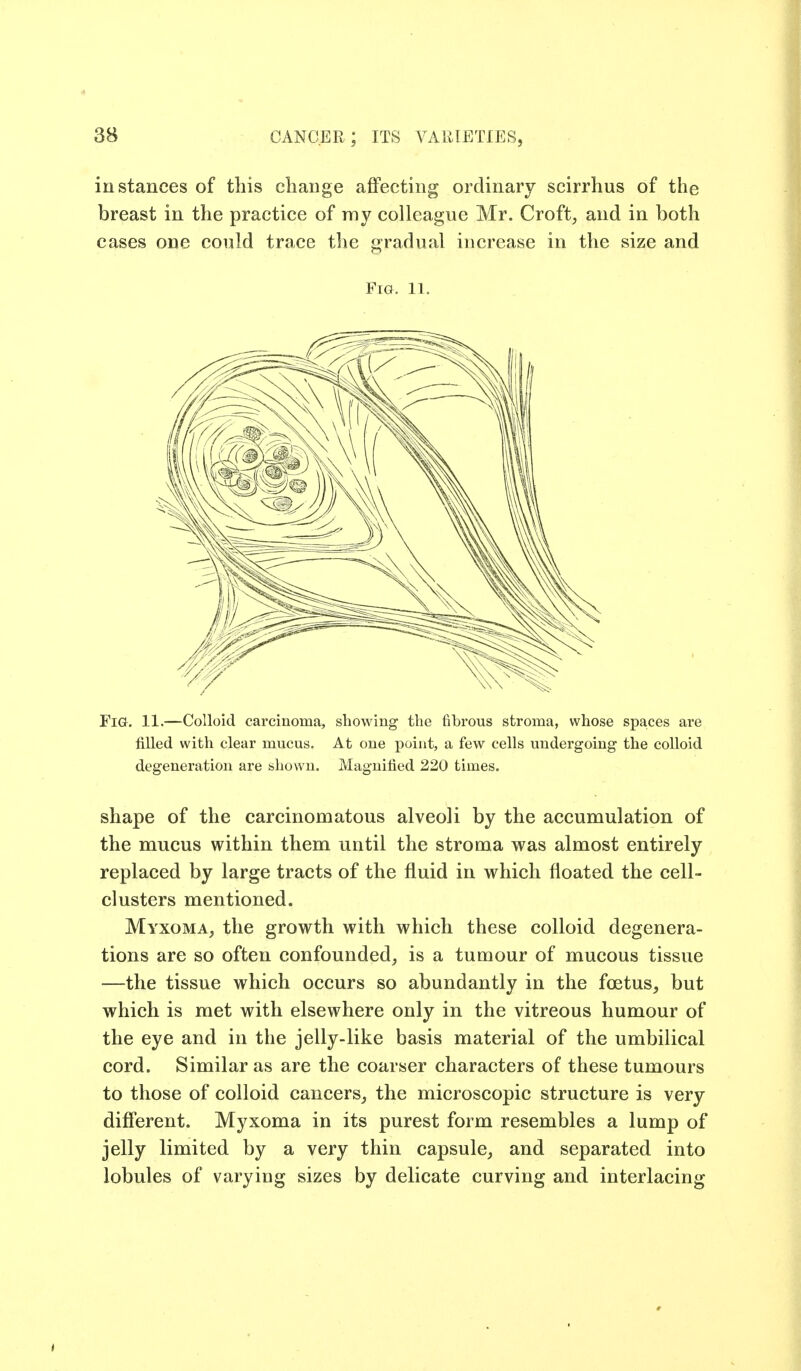 instances of this change affecting ordinary scirrhus of the breast in the practice of my colleague Mr. Croft, and in both cases one could trace the gradual increase in the size and Fig. 11. Fig. 11.—Colloid carcinoma, showing the fibrous stroma, whose spaces are filled with clear mucus. At one point, a few cells undergoing the colloid degeneration are shown. Magnified 220 times. shape of the carcinomatous alveoli by the accumulation of the mucus within them until the stroma was almost entirely replaced by large tracts of the fluid in which floated the cell- clusters mentioned. Myxoma, the growth with which these colloid degenera- tions are so often confounded, is a tumour of mucous tissue —the tissue which occurs so abundantly in the fcetus, but which is met with elsewhere only in the vitreous humour of the eye and in the jelly-like basis material of the umbilical cord. Similar as are the coarser characters of these tumours to those of colloid cancers, the microscopic structure is very difi'erent. Myxoma in its purest form resembles a lump of jelly limited by a very thin capsule, and separated into lobules of varying sizes by delicate curving and interlacing