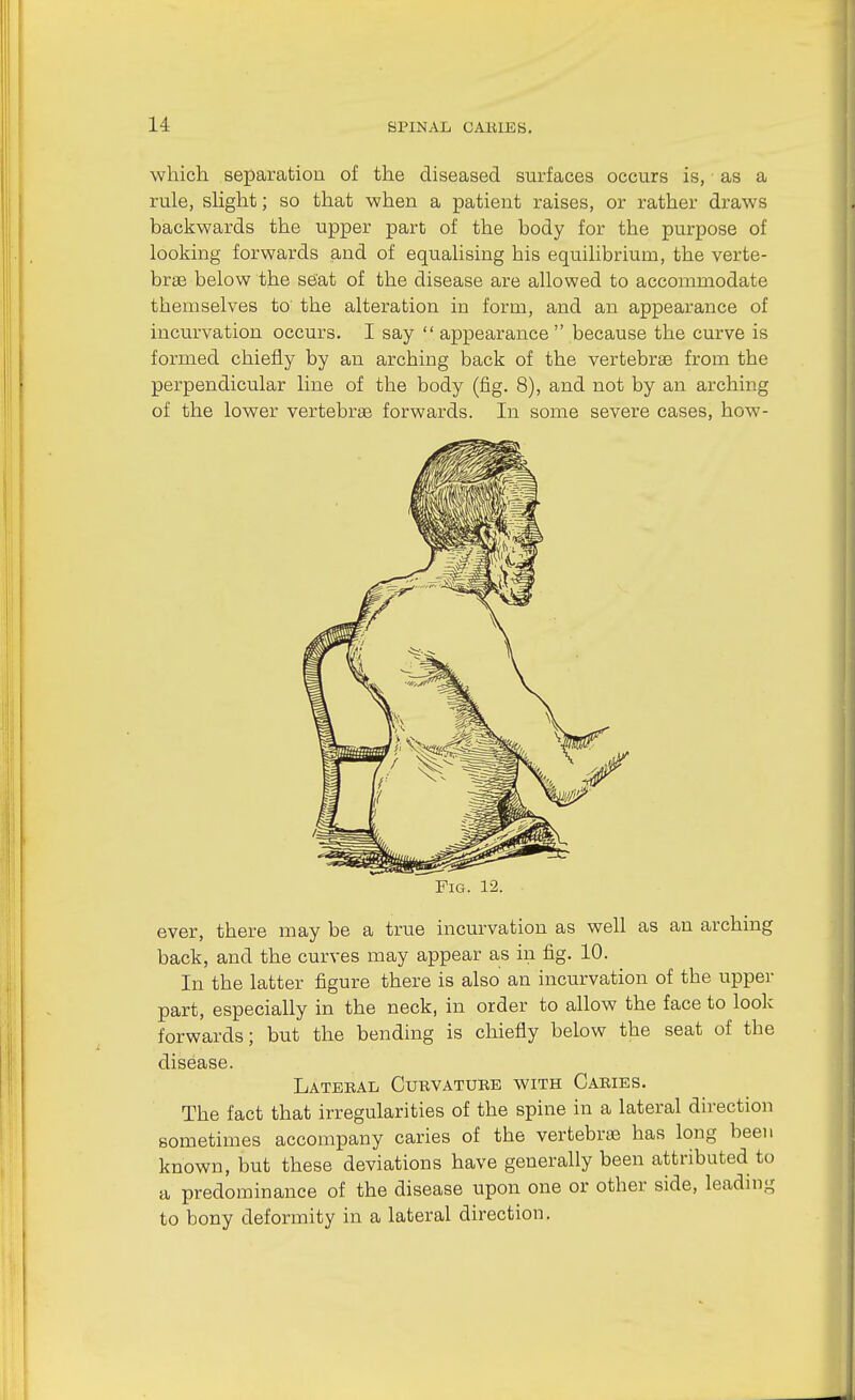 which separation of the diseased surfaces occurs is, as a rule, shght; so that when a patient raises, or rather draws baclfwards the upper part of the body for the purpose of looking forwards and of equalising his equilibrium, the verte- brae below the s6'at of the disease are allowed to accommodate themselves to the alteration in form, and an appearance of incurvation occurs. I say  appearance  because the curve is formed chiefly by an arching back of the vertebrae from the perpendicular line of the body (fig. 8), and not by an arching of the lower vertebrae forwards. In some severe cases, how- FiG. 12. ever, there may be a true incurvation as well as an arching back, and the curves may appear as in fig. 10. In the latter figure there is also an incurvation of the upper part, especially in the neck, in order to allow the face to look forwards; but the bending is chiefly below the seat of the disease. Latebal Cubvatube with Cabies. The fact that irregularities of the spine in a lateral dii-ection sometimes accompany caries of the vertebrte has long been known, but these deviations have generally been attributed to a predominance of the disease upon one or other side, leading to bony deformity in a lateral direction.