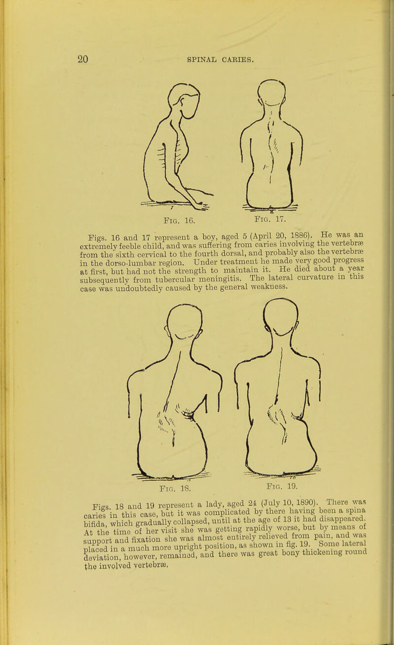 Fig. 16. Fig. 17. Figs. 16 and 17 represent a boy, aged 5 (April 20, 1886). He was an extremely feeble child, and was suffering from caries involving the vertebrae from the sixth cervical to the fourth dorsal, and probably also the vertebrae in the dorso-lumbar region. Under treatment he made very good progress at first, but had not the strength to maintain it. He died about a year subsequently from tubercular meningitis. The lateral curvature m ttus case was undoubtedly caused by the general weakness. Ftg. Fies 18 and 19 represent a lady, aged 24 (July 10, 1890). There was caries in this case, but it was complicated by there having been a spina bmda which gradually collapsed, until at the age of 13 it had disappeared At t£e tfmo of her vilit she was getting rapidly worse, but by means of snuDort and fixation she was almost eotLrely relieved from pam, and was ir? a much more upright position, as shown in fig. 19. Some lateral SevStiJn,Vrever remaLod^ aSd there was great bony thickening round the involved vertebrse,