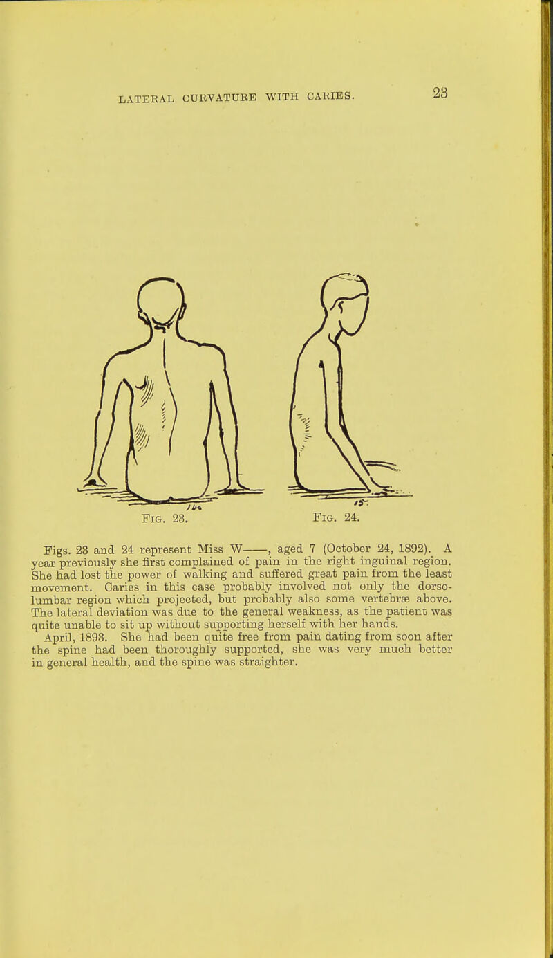 Pig. 23. Figs. 23 and 24 represent Miss W , aged 7 (October 24, 1892). A year previously she first complained of pain in the right inguinal region. She had lost the power of walking and suffered great pain from the least movement. Caries in this case probably involved not only the dorso- lumbar region which projected, but probably also some vertebrae above. The lateral deviation was due to the general weakness, as the patient was quite unable to sit up without supporting herself with her hands. April, 1893. She had been quite free from pain dating from soon after the spine had been thoroughly supported, she was very much better in general health, and the spine was straighter.