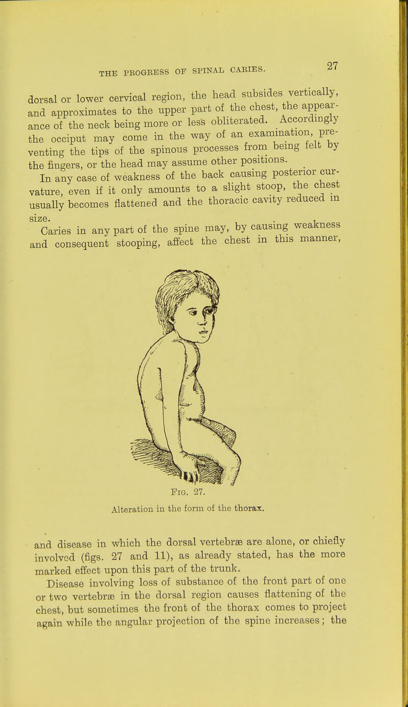 dorsal or lower cervical region, the head subsides vertically, and approximates to the upper part of the chest, the appear- ance of the neck being more or less obliterated. Accordingly the occiput may come in the way of an examination, pre- venting the tips of the spinous processes from bemg felt by the fingers, or the head may assume other positions. In any case of weakness of the back causing posterior cur- vature, even if it only amounts to a slight stoop, the chest usually becomes flattened and the thoracic cavity reduced m size. . , Caries in any part of the spine may, by causmg weakness and consequent stooping, affect the chest m this manner. Fig. 27. Alteration in the form of the thorax. and disease in which the dorsal vertebrae are alone, or chiefly involved (figs. 27 and 11), as already stated, has the more marked effect upon this part of the trunk. Disease involving loss of substance of the front part of one or two vertebrae in the dorsal region causes flattening of the chest, but sometimes the front of the thorax comes to project again while the angular projection of the spine increases; the
