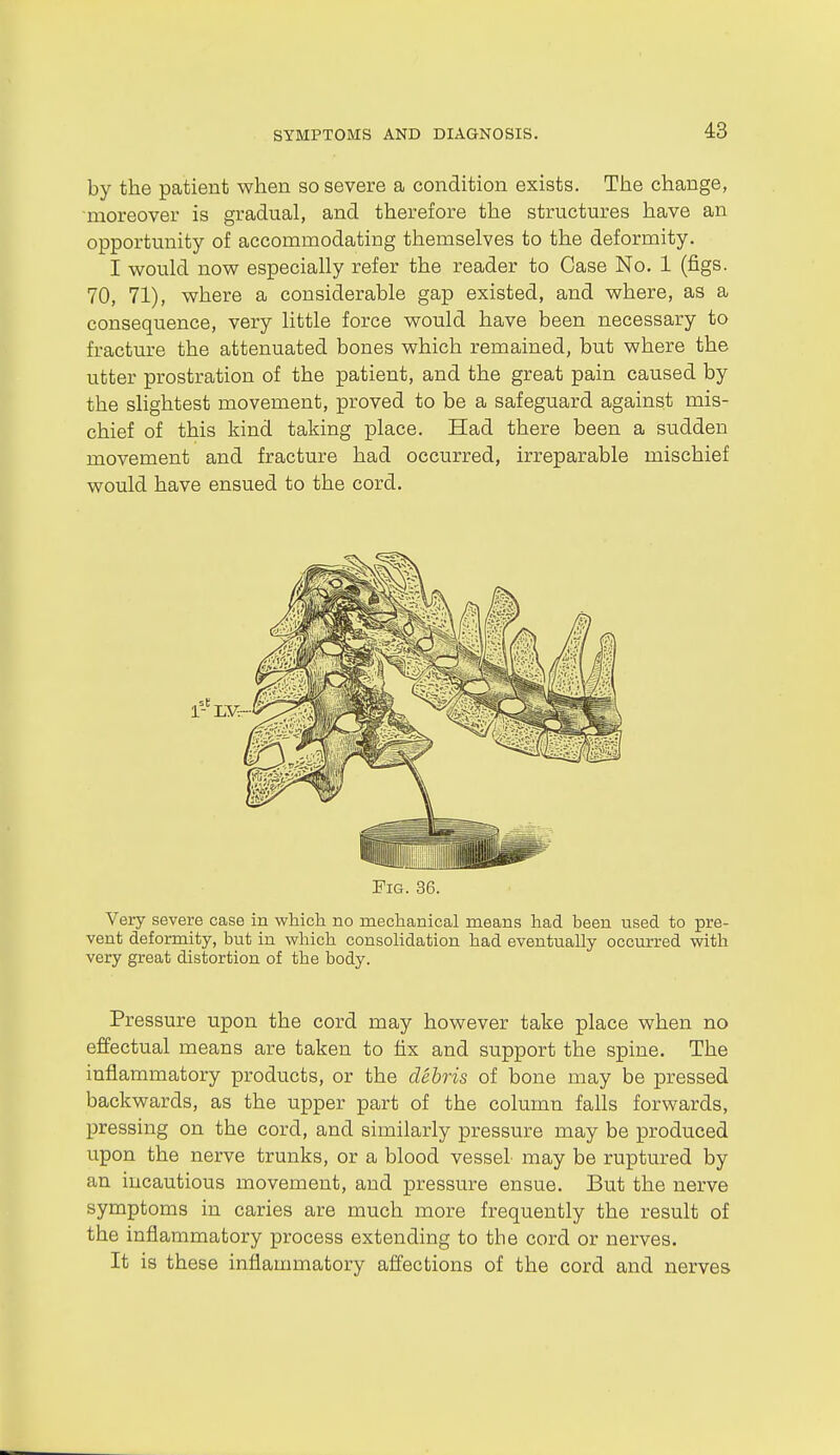 by the patient when so severe a condition exists. The change, moreover is gradual, and therefore the structures have an opportunity of accommodating themselves to the deformity. I would now especially refer the reader to Case No. 1 (figs. 70, 71), where a considerable gap existed, and where, as a consequence, very little force would have been necessary to fracture the attenuated bones which remained, but where the utter prostration of the patient, and the great pain caused by the slightest movement, proved to be a safeguard against mis- chief of this kind taking place. Had there been a sudden movement and fracture had occurred, irreparable mischief would have ensued to the cord. Fig. 36. Very severe case in which no mechanical means had been used to pre- vent deformity, but in which consolidation had eventually occurred with very great distortion of the body. Pressure upon the cord may however take place when no effectual means are taken to fix and support the spine. The inflammatory products, or the debris of bone may be pressed backwards, as the upper part of the column falls forwards, pressing on the cord, and similarly pressure may be produced upon the nerve trunks, or a blood vessel may be ruptured by an incautious movement, and pressure ensue. But the nerve symptoms in caries are much more frequently the result of the inflammatory process extending to the cord or nerves. It is these inflammatory affections of the cord and nerves