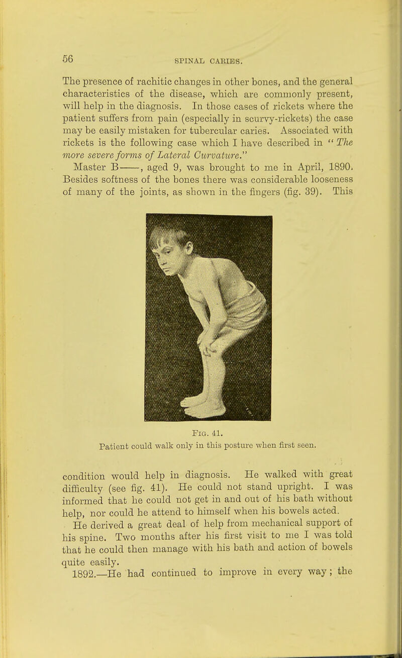 The presence of rachitic changes in other bones, and the general characteristics of the disease, which are commonly present, will help in the diagnosis. In those cases of rickets where the patient suffers from pain (especially in scurvy-rickets) the case may be easily mistaken for tubercular caries. Associated with rickets is the following case which I have described in  The more severe forms of Lateral Curvature.' Master B , aged 9, was brought to me in April, 1890. Besides softness of the bones there was considerable looseness of many of the joints, as shown in the fingers (fig. 39). This Fig. 41. Patient could walk only in this posture when first seen. condition would help in diagnosis. He walked with great difficulty (see fig. 41). He could not stand upright. I was informed that he could not get in and out of his bath without help, nor could he attend to himself when his bowels acted. He derived a great deal of help from mechanical support of his spine. Two months after his first visit to me I was told that he could then manage with his bath and action of bowels quite easily. 1892.—He had continued to improve in every way; the