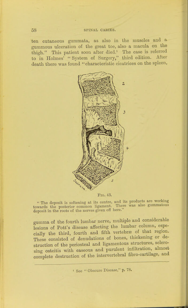 ten cutaneous gummata, as also in the muscles and a gummous ulceration of the great toe, also a macula on the thigh. This patient soon after died.^ The case is referred to in Holmes' *' System of Surgery, third edition. After death there was found characteristic cicatrices on the spleen, Fig. 43.  The deposit is softening at its centre, and its products are working towards the posterior common ligament. There was also gimimatous deposit in the roots of the nerves given off here. gumma of the fourth lumbar nerve, multiple and considerable lesions of Pott's disease affecting the lumbar column, espe- cially the third, fourth and fifth vertebr£e of that region. These consisted of denudations of bones, thickenmg or de- struction of the periosteal and ligamentous structures, sclero- sing osteitis with caseous and purulent infiltration, almost complete destruction of the intervertebral fibro-cartilage, and ' See  Obscure Disease, p. 78.