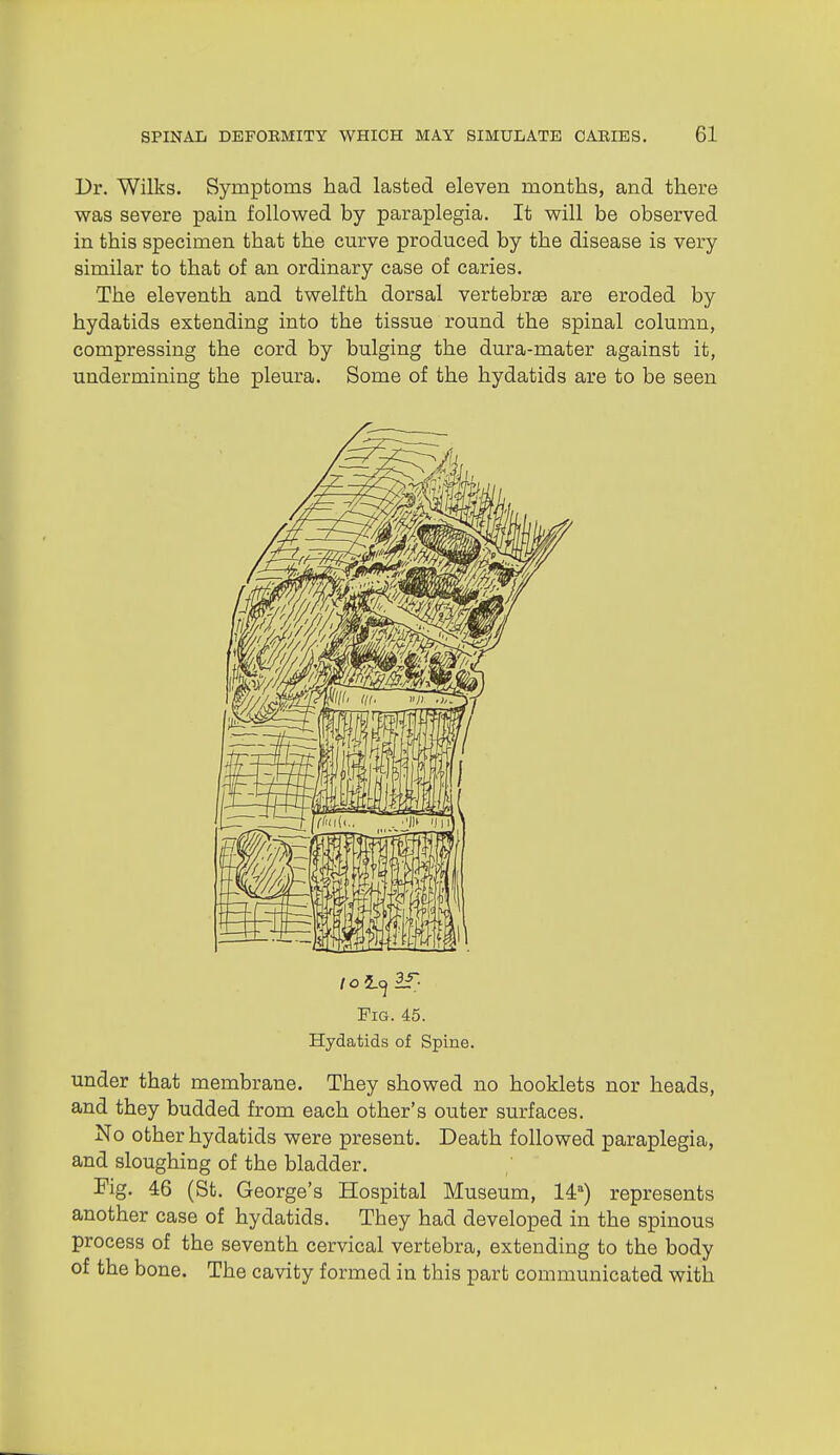 Dr. Wilks. Symptoms had lasted eleven months, and there was severe pain followed by paraplegia. It will be observed in this specimen that the curve produced by the disease is very similar to that of an ordinary case of caries. The eleventh and twelfth dorsal vertebrae are eroded by hydatids extending into the tissue round the spinal column, compressing the cord by bulging the dura-mater against it, undermining the pleura. Some of the hydatids are to be seen Fig. 45. Hydatids of Spine. under that membrane. They showed no booklets nor heads, and they budded from each other's outer surfaces. No other hydatids were present. Death followed paraplegia, and sloughing of the bladder. Fig. 46 (St. George's Hospital Museum, 14) represents another case of hydatids. They had developed in the spinous process of the seventh cervical vertebra, extending to the body of the bone. The cavity formed in this part communicated with