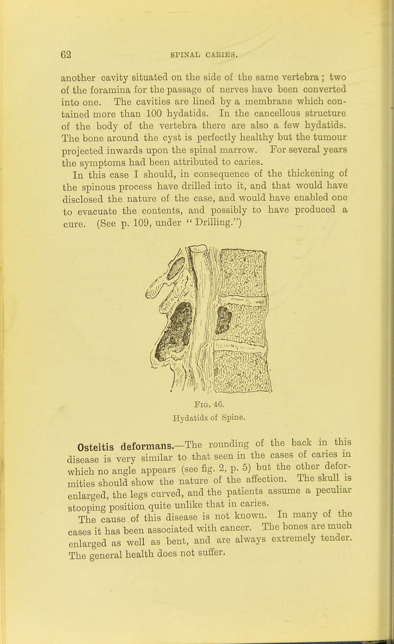 another cavity situated on the side of the same vertebra ; two of the foramina for the passage of nerves have been converted into one. The cavities are hned by a membrane which con- tained more than 100 hydatids. In the cancellous structure of the body of the vertebra there are also a few hydatids. The bone around the cyst is perfectly healthy but the tumour projected inwards upon the spinal marrow. For several years the symptoms had been attributed to caries. In this case I should, in consequence of the thickening of the spinous process have drilled into it, and that would have disclosed the nature of the case, and would have enabled one to evacuate the contents, and possibly to have produced a cure. (See p. 109, under  Drilling.) Osteitis deformans.—The rounding of the back m this disease is very similar to that seen in the cases of caries m which no angle appears (see fig. 2, p. 5) but the other defor- mities should show the nature of the affection. The skull is enlarged, the legs curved, and the patients assume a peculiar stooping position quite unlike that in caries. The cause of this disease is not known. In many of the cases it has been associated with cancer. The bones are much enlarged as well as bent, and are always extremely tender. The general health does not suffer.
