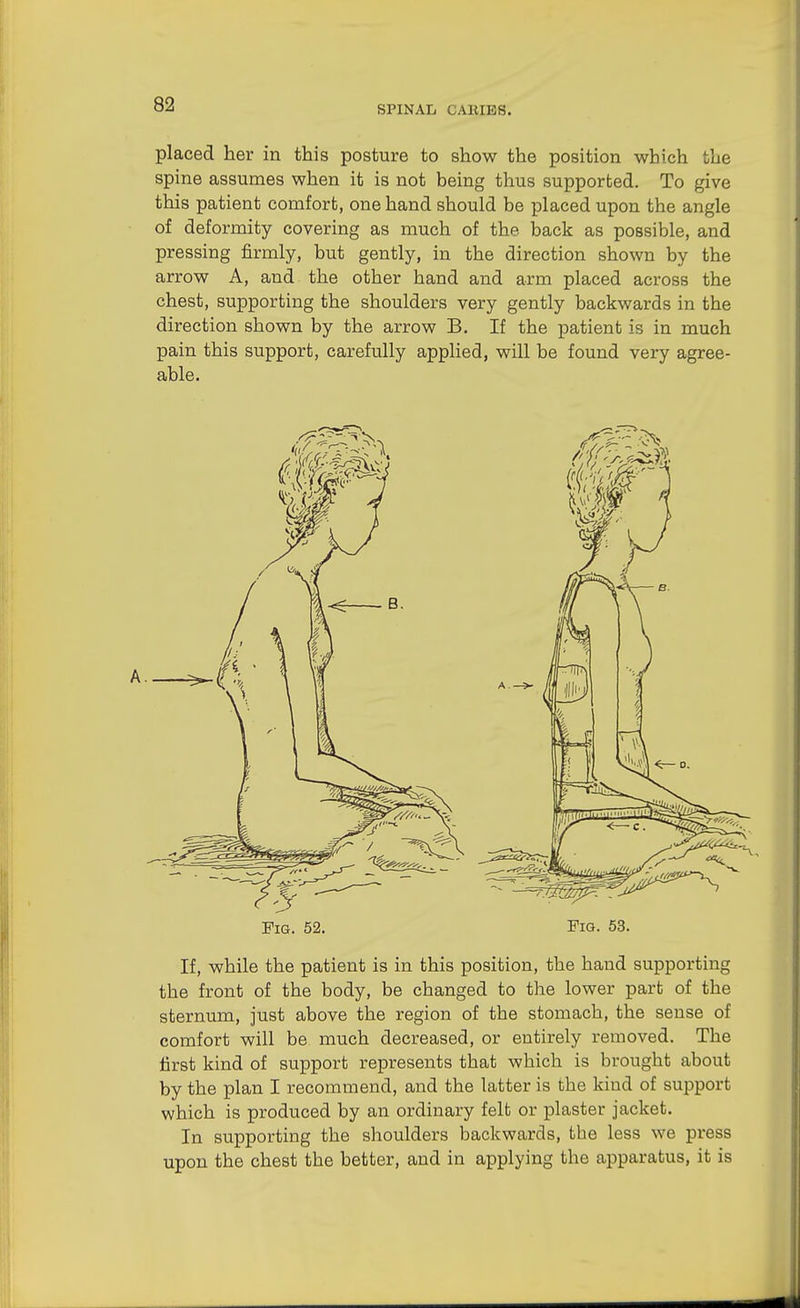 SPINAL CABIBS. placed her in this posture to show the position which the spine assumes when it is not being thus supported. To give this patient comfort, one hand should be placed upon the angle of deformity covering as much of the back as possible, and pressing firmly, but gently, in the direction shown by the arrow A, and the other hand and arm placed across the chest, supporting the shoulders very gently backwards in the direction shown by the arrow B. If the patient is in much pain this support, carefully applied, will be found very agree- able. Fig. 52. Fig. 53. If, while the patient is in this position, the hand supporting the front of the body, be changed to the lower part of the sternum, just above the region of the stomach, the sense of comfort will be much decreased, or entirely removed. The first kind of support represents that which is brought about by the plan I recommend, and the latter is the kind of support which is produced by an ordinary felt or plaster jacket. In supporting the shoulders backwards, the less we press upon the chest the better, and in applying the apparatus, it is