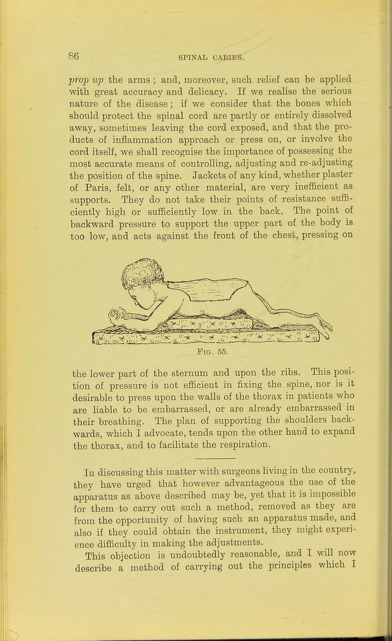 prop up the arms ; and, moreover, such relief can be applied with great accuracy and delicacy. If we realise the serious nature of the disease ; if we consider that the bones which should protect the spinal cord are partly or entirely dissolved away, sometimes leaving the cord exposed, and that the pro- ducts of inflammation approach or press on, or involve the cord itself, we shall recognise the importance of possessing the most accurate means of controlling, adjusting and re-adjusting the position of the spine. Jackets of any kind, whether plaster of Paris, felt, or any other material, are very inefficient as supports. They do not take their points of resistance suffi- ciently high or sufficiently low in the back. The point of backward pressure to support the upper part of the body is too low, and acts against the front of the chest, pressing on Fig. 55. the lower part of the sternum and upon the ribs. This posi- tion of pressure is not efficient in fixing the spine, nor is it desirable to press upon the walls of the thorax in patients who are liable to be embarrassed, or are already embarrassed in their breathing. The plan of supporting the shoulders back- wards, which I advocate, tends upon the other hand to expand the thorax, and to facilitate the respiration. In discussing this matter with surgeons living in the country, they have urged that however advantageous the use of the apparatus as above described may be, yet that it is impossible for them to carry out such a method, removed as they are from the opportunity of having such an apparatus made, and also if they could obtain the instrument, they might experi- ence difficulty in making the adjustments. This objection is undoubtedly reasonable, and I will now describe a method of carrying out the principles which I