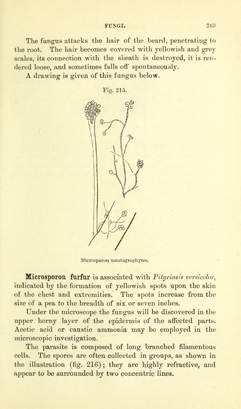 The fungus attacks tlie hair of the beard, penetrating to the root. The hair becomes covered with yellowish and grey scales, its connection with the sheath is destroyed, it is ren- dered loose, and sometimes falls off' spontaneously, A drawing is given of this fungus below. Microsporon furfur is associated with Pityriasis versicolor^ indicated by the formation of yellowish spots upon the skin of the chest and. extremities. The spots increase from the size of a pea to the breadth of six or seven inches. Under the microscope the fungus will be discovered in the upper horny layer of the epidermis of the affected parts. Acetic acid or caustic ammonia may be employed in the microscopic investigation. The parasite is composed of long branched filamentous cells. The spores are often collected in groups, as shown in the illustration (fig. 216); they are highly refractive, and appear to be surrounded by two concentric lines. Fig. 215.