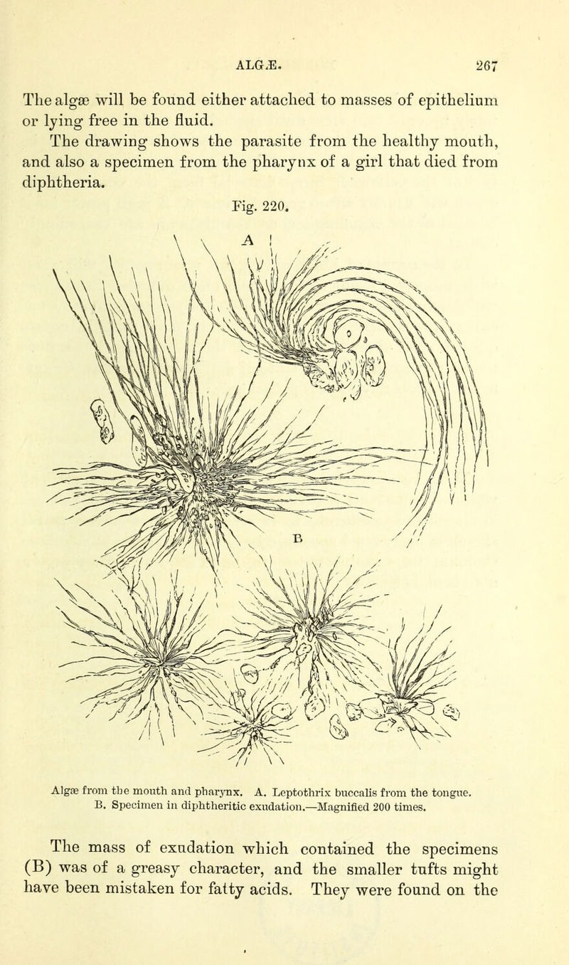 The algae will be found either attached to masses of epithelium or lying free in the fluid. The drawing shows the parasite from the healthy mouth, and also a specimen from the pharynx of a girl that died from diphtheria. Fig. 220. Algas from the mouth and pharynx. A. Leptothrix buccalis from the tongue. B. Specimen in diphtheritic exudation.—Magnified 200 times. The mass of exudation which contained the specimens (B) was of a greasy character, and the smaller tufts might have been mistaken for fatty acids. They were found on the