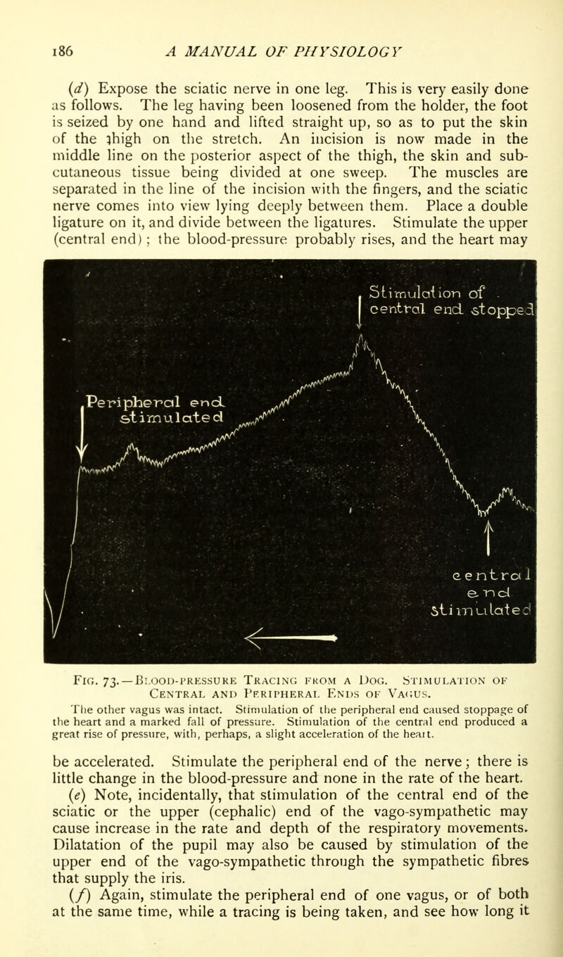 (d) Expose the sciatic nerve in one leg. This is very easily done as follows. The leg having been loosened from the holder, the foot is seized by one hand and lifted straight up, so as to put the skin of the ihigh on the stretch. An incision is now made in the middle line on the posterior aspect of the thigh, the skin and sub- cutaneous tissue being divided at one sweep. The muscles are separated in the line of the incision with the fingers, and the sciatic nerve comes into view lying deeply between them. Place a double ligature on it, and divide between the ligatures. Stimulate the upper (central end); the blood-pressure probably rises, and the heart may Fig, 73. —B.m301)-i'rkssure Tracing from a Dog. Stimulation of Central and Peripheral Ends of Va(;us. The other vagus was intact. Stimulation of tlie peripheral end caused stoppage of the heart and a marked fall of pressure. Stimulation of the central end produced a great rise of pressure, with, perhaps, a slight acceleration of the heait. be accelerated. Stimulate the peripheral end of the nerve; there is little change in the blood-pressure and none in the rate of the heart. (e) Note, incidentally, that stimulation of the central end of the sciatic or the upper (cephalic) end of the vago-sympathetic may cause increase in the rate and depth of the respiratory movements. Dilatation of the pupil may also be caused by stimulation of the upper end of the vago-sympathetic through the sympathetic fibres that supply the iris. (/) Again, stimulate the peripheral end of one vagus, or of both at the same time, while a tracing is being taken, and see how long it