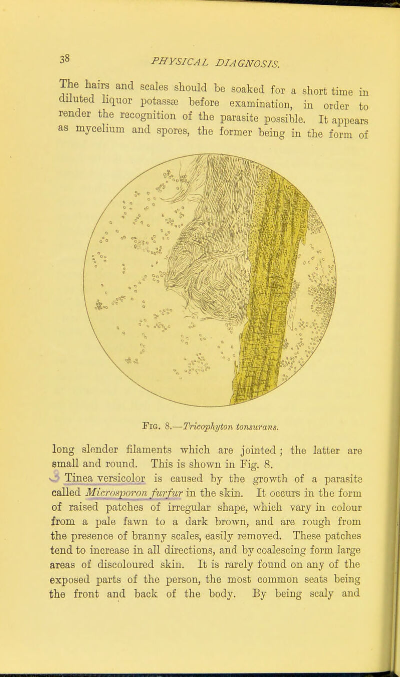 The hairs and scales should be soaked for a short time in diluted liquor potassse before examination, in order to render the recognition of the parasite possible. It appears as mycelium and spores, the former being in the form of Fig. 8.—Tricophyton tonsurans. long slender filaments which are jointed; the latter are small and round. This is shown in Fig. 8. - Tinea versicolor is caused by the growth of a parasite called Microsjioron furfur in the skin. It occurs in tbe form of raised patches of irregular shape, which vary in colour from a pale fawn to a dark brown, and are rough from the presence of branny scales, easily removed. These patches tend to increase in all directions, and by coalescing form large areas of discoloured skin. It is rarely found on any of the exposed parts of the person, the most common seats being the front and back of the body. By being scaly and