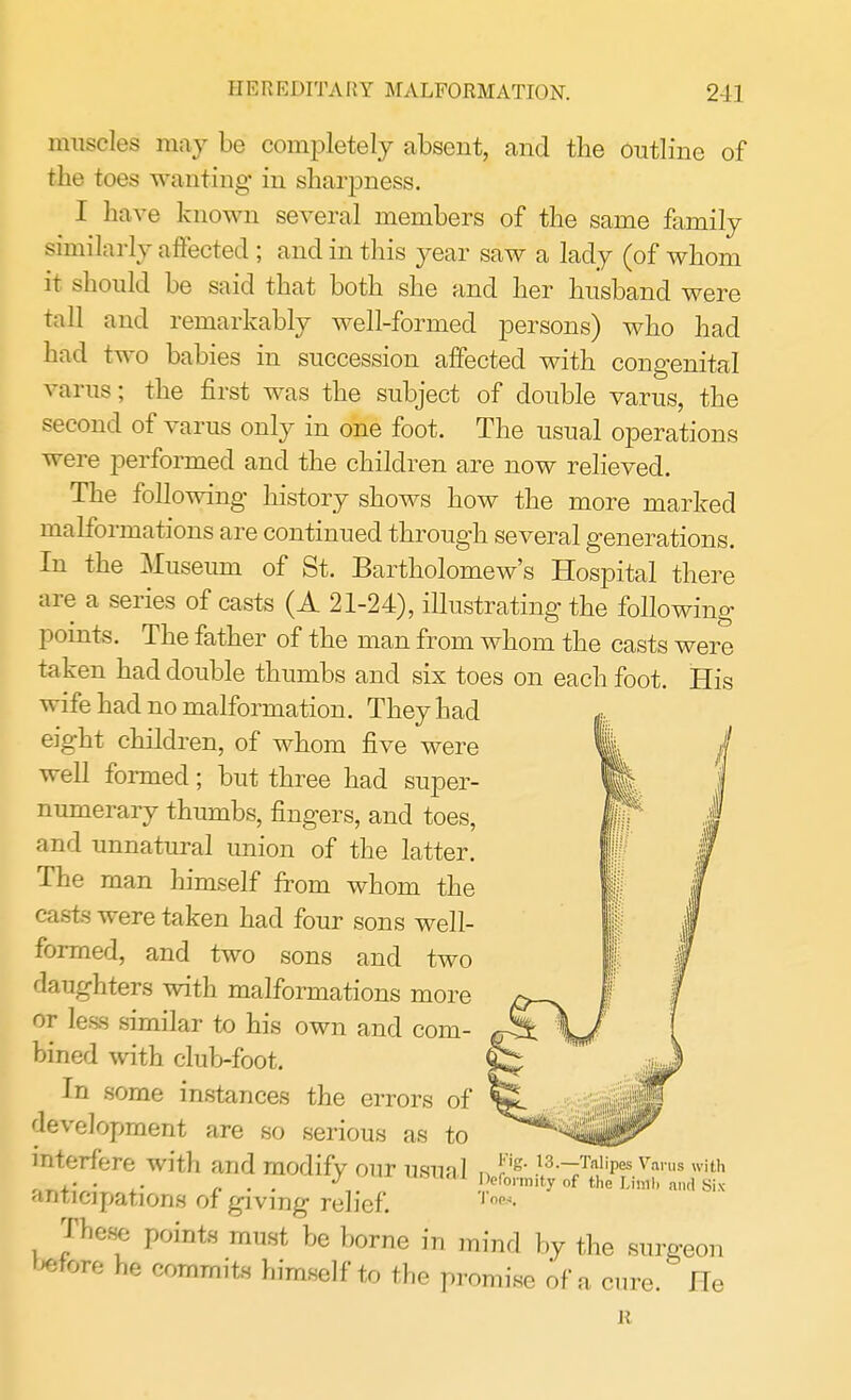 muscles may be completely absent, and the outline of the toes wanting in sharpness. I have known several members of the same family similarly affected ; and in this year saw a lady (of whom it should be said that both she and her husband were Tall and remarkably well-formed persons) who had had two babies in succession affected with congenital varus; the first was the subject of double varus, the second of varus only in one foot. The usual operations were performed and the children are now relieved. The following history shows how the more marked malformations are continued through several generations. In the Museum of St. Bartholomew's Hospital there are a series of casts (A 21-24), illustrating the following points. The father of the man from whom the casts were taken had double thumbs and six toes on each foot. His wife had no malformation. They had eight children, of whom five were well formed; but three had super- numerary thumbs, fingers, and toes, and unnatural union of the latter. The man himself from whom the casts were taken had four sons well- formed, and two sons and two daughters with malformations more or less similar to his own and com- bined with club-foot. In some instances the errors of development are so serious as to interfere with and modify our usual anticipations of giving relief. These points must be borne in mind by the surgeon WtfTO he commits himself to the promise of a cure. He R Fig. 13.—Talipes Virus with Deformity of the Limb and Six Tops.