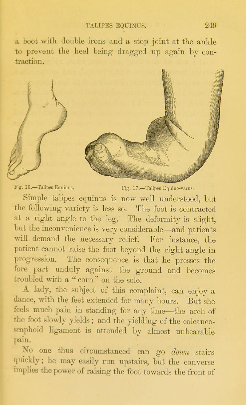 a boot with double irons and a stop joint at the ankle to prevent the heel being dragged up again by con- traction. F g. 16.—Talipes Equinus. Fig. 17.—Talipes Equino-varus. Simple talipes equinus is now well understood, but the following variety is less so. The foot is contracted at a right angle to the leg. The deformity is slight, but the inconvenience is very considerable—and patients will demand the necessary relief. For instance, the patient cannot raise the foot beyond the right angle in progression. The consequence is that he presses the fore part unduly against the ground and becomes troubled with a  corn  on the sole. A lady, the subject of this complaint, can enjoy a dance, with the feet extended for many hours. But she feels much pain in standing for any time—the arch of the foot slowly yields; and the yielding of the calcaneo- scaphoid ligament is attended by almost unbearable pain. Xo one thus circumstanced can go down stairs 'I'iK.kly; he may easily run upstairs, but the converse irn plies the power of raising the foot towards the front of