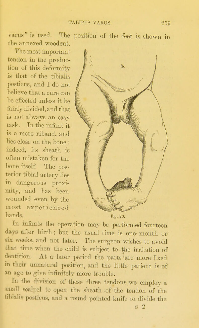 TALIPES VARUS. varus is used. The position of the feet is shown in the annexed woodcut. The most important tendon in the produc- tion of this deformity- is that of the tibialis posticus, and I do not believe that a cure can be effected unless it be fairly divided, and that is not always an easy task. In the infant it is a mere riband, and lies close on the bone : indeed, its sheath is often mistaken for the bone itself. The pos- terior tibial artery lies in dangerous proxi- mity, and has been wounded even by the most experienced hands. Fig. 20. In infants the operation may be performed fourteen days after birth; but the usual time is one- month or six weeks, and not later. The surgeon wishes to avoid that time when the child is subject to 1jhe irritation of dentition. At a later period the parts 'are more fixed in their unnatural position, and the little patient is of an age to give infinitely more trouble. In the division of these three tendons we employ a .small scalpel to open the sheath of the tendon of the tibialis posticus, and round pointed knife to divide the s 2