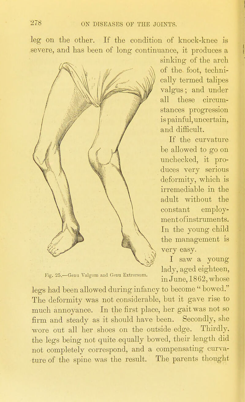 leg on the other. If the condition of knock-knee is severe, and has been of long continuance, it produces a sinking of the arch of the foot, techni- cally termed talipes valgus; and under all these circum- stances progression is painful,uncertain, and difficult. If the curvature be allowed to go on unchecked, it pro- duces very serious deformity, which is irremediable in the adult without the constant employ- ment of instruments. In the young child the management is very easy. I saw a young- lady, aged eighteen, in June, 1862, whose Fig. 25.—Genu Valgum and Genu Extrorsum. legs had been allowed during infancy to become bowed. The deformity was not considerable, but it gave rise to much annoyance. In the first place, her gait was not so firm and steady as it should have been. Secondly, she wore out all her shoes on the outside edge. Thirdly, the legs being not quite equally bowed, their length did not completely correspond, and a compensating curva- ture of the spine was the result. The parents thought
