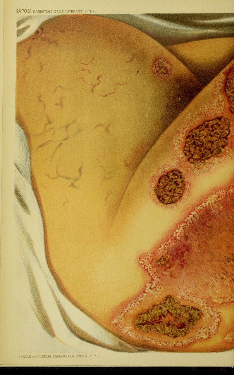 KAPOSI HANDATLAS DER HAUTKRANKHEITEN VERLAG von WILHELM BRAUMÜIIEK.WENaLEIPZKj