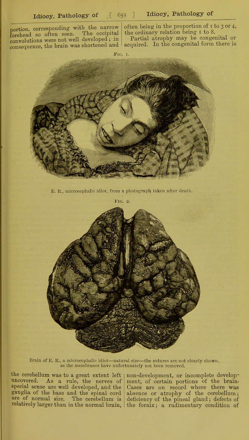 portion, corresponding with the narrow forehead so often seen. The occipital convolutions were not well developed ; in consequence, the brain was shortened and often being in the proportion of i to 3 or 4, the ordinary relation being i to 8. Partial atrophy may be congenital or acquired. In the congenital form there is Fl<!. T. E. 11., microceplialic idiot, from a photograph taken alter deatli. Eig. 2. iSraln of E. E., a mierocephalic idiot—natural .size—the suture.s arc not clearly shown, as the membranes have unlortunately not boon removed. the cerebellum was to a great extent left uncovered. As a rule, the nerves of special sense are well developed, and the ganglia of the base and the spinal cord are of normal size. The cerebellum is relatively larger than in the normal brain, non-development, or incomplete develop- ment, of certain portions of the brain- Oases are on record where there was absence or atrophy of the cerebellum; deficiency of the pineal gland; defects of the fornix; a rudimentary condition of