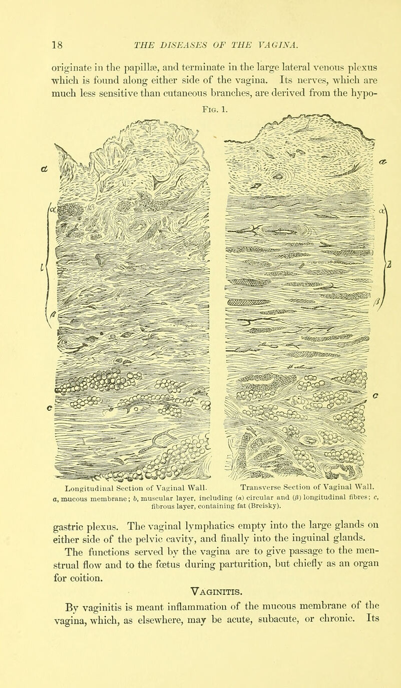 originate in the papillae, and terminate in the large lateral venous plexus which is found along either side of the vagina. Its nerves, which are much less sensitive than cutaneous branches, are derived from the hypo- Fig. 1. Longitudinal Section of Vaginal Wall. Transverse Section of Vaginal Wall. a, mucous membrane; 6, muscular layer, including (a) circular and O) longitudinal fibres; c, fibrous layer, containing fat (Breisky). gastric plexus. The vaginal lymphatics empty into the large glands on either side of the pelvic cavity, and finally into the inguinal glands. The functions served by the vagina are to give passage to the men- strual flow and to the foetus during parturition, but chiefly as an organ for coition. Vaginitis. By vaginitis is meant inflammation of the mucous membrane of the vagina, which, as elsewhere, may be acute, subacute, or chronic. Its