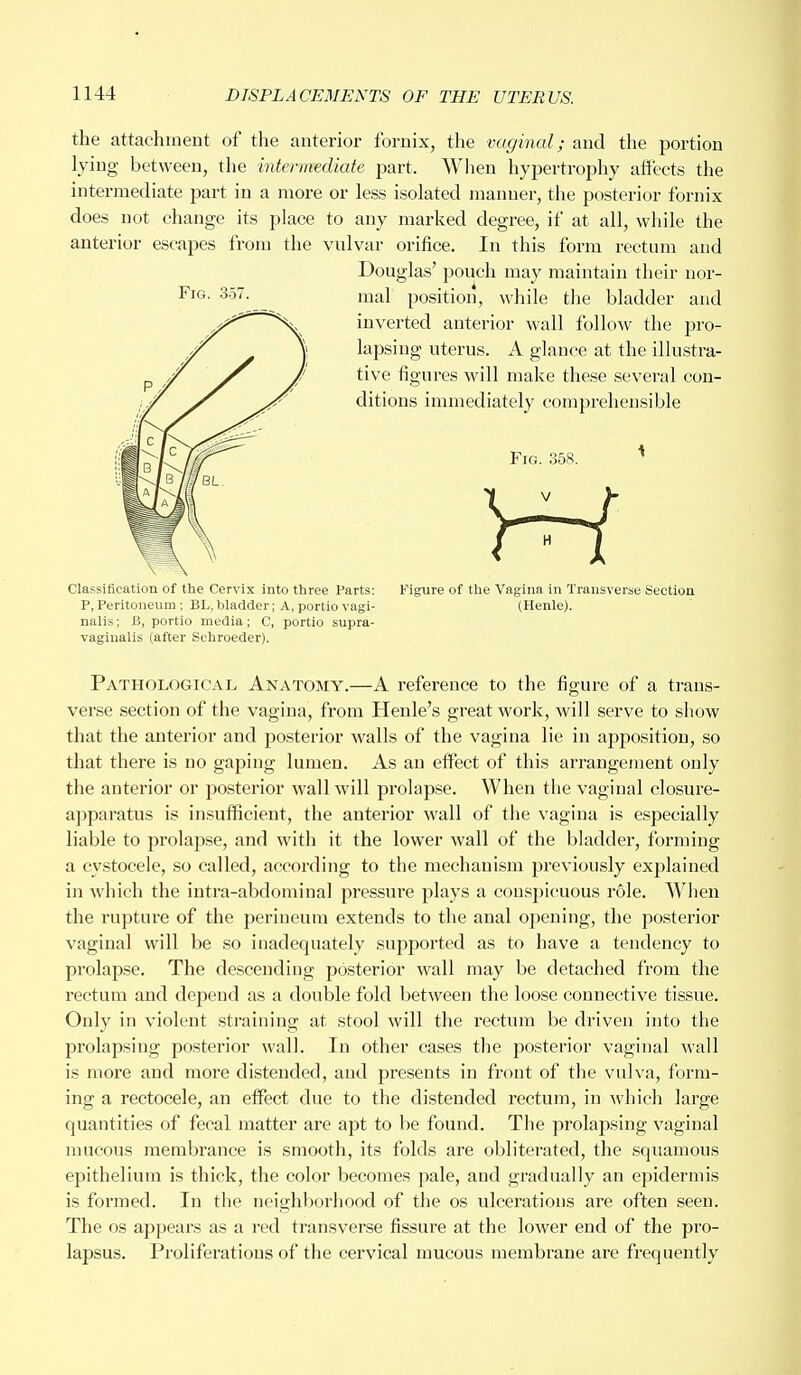 the attachment of the anterior fornix, the vaginal; and the portion lying between, the intermediate part. When hypertrophy affects the intermediate part in a more or less isolated manner, the posterior fornix does not change its place to any marked degree, if at all, while the anterior escapes from the vulvar orifice. In this form rectum and Douglas' pouch may maintain their nor- mal position, while the bladder and inverted anterior wall follow the pro- lapsing uterus. A glance at the illustra- tive figures will make these several con- ditions immediately comprehensible Fig. 358. 1 YH Classification of the Cervix into three Parts: Figure of the Vagina in Transverse Section P, Peritoneum ; BL, bladder; A, portio vagi- (Henle). nalis; B, portio media; C, portio supra- vaginal (after Sehroeder). Pathological Anatomy.—A reference to the figure of a trans- verse section of the vagina, from Henle's great work, will serve to show that the anterior and posterior walls of the vagina lie in apposition, so that there is no gaping lumen. As an effect of this arrangement only the anterior or posterior wall will prolapse. When the vaginal closure- apparatus is insufficient, the anterior wall of the vagina is especially liable to prolapse, and with it the lower wall of the bladder, forming a cystocele, so called, according to the mechanism previously explained in which the intra-abdominal pressui'e plays a cousjncuous role. When the rupture of the perineum extends to the anal opening, the posterior vaginal will be so inadequately supported as to have a tendency to prolapse. The descending posterior wall may be detached from the rectum and depend as a double fold between the loose connective tissue. Only in violent straining at stool will the rectum be driven into the prolapsing posterior wall. In other cases the posterior vaginal wall is more and more distended, and presents in front of the vulva, form- ing a rectocele, an effect due to the distended rectum, in which large quantities of fecal matter are apt to be found. The jirolapsing vaginal mucous membrance is smooth, its folds are obliterated, the squamous epithelium is thick, the color becomes pale, and gradually an epidermis is formed. In the neighborhood of the os ulcerations are often seen. The os appears as a red transverse fissure at the lower end of the pro- lapsus. Proliferations of the cervical mucous membrane are frequently