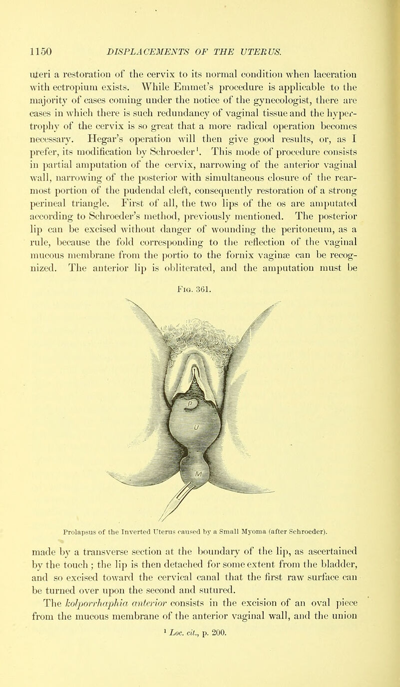 uteri a restoration of the cervix to its normal condition when laceration with ectropiurn exists. While Emmet's procedure is applicable to the majority of cases coining under the notice of the gynecologist, there are cases in which there is such redundancy of vaginal tissue and the hyper- trophy of the cervix is so great that a more radical operation becomes necessary. Hegar's operation will then give good results, or, as I prefer, its modification by Schroeder'. This mode of procedure consists in partial amputation of the cervix, narrowing of the anterior vaginal wall, narrowing of the posterior with simultaneous closure of the rear- most portion of the pudendal cleft, consequently restoration of a strong perineal triangle. First of all, the two lips of the os are amputated according to Schroeder's method, previously mentioned. The posterior lip can be excised without danger of wounding the peritoneum, as a rule, because the fold corresponding to the reflection of the vaginal mucous membrane from the portio to the fornix vaginae can be recog- nized. The anterior lip is obliterated, and the amputation must be Fig. 361. Prolapsus of the Inverted Uterus caused by a Small Myoma (after Schroeder). made by a transverse section at the boundary of the lip, as ascertained by the touch ; the lip is then detached for some extent from the bladder, and so excised toward the cervical canal that the first raw surface can be turned over upon the second and sutured. The koljiorrhaphia anterior consists in the excision of an oval piece from the mucous membrane of the anterior vaginal wall, and the union