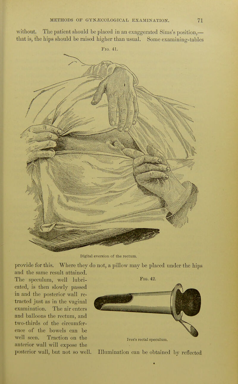 without. The patient should be placed in an exaggerated Sims's position,— that is, the hips should be raised higher than usual. Some exarnining-tables Fig. 41. Digital eversion of the rectum. provide for this. Where they do not, a pillow may be placed under the hips and the same result attained. The speculum, well lubri- cated, is then slowly passed in and the posterior wall re- tracted just as in the vaginal examination. The air enters and balloons the rectum, and two-thirds of the circumfer- ence of the bowels can be well seen. Traction on the Ives's rectal speculum, anterior wall will expose the posterior wall, but not so well. Illumination can be obtained by reflected