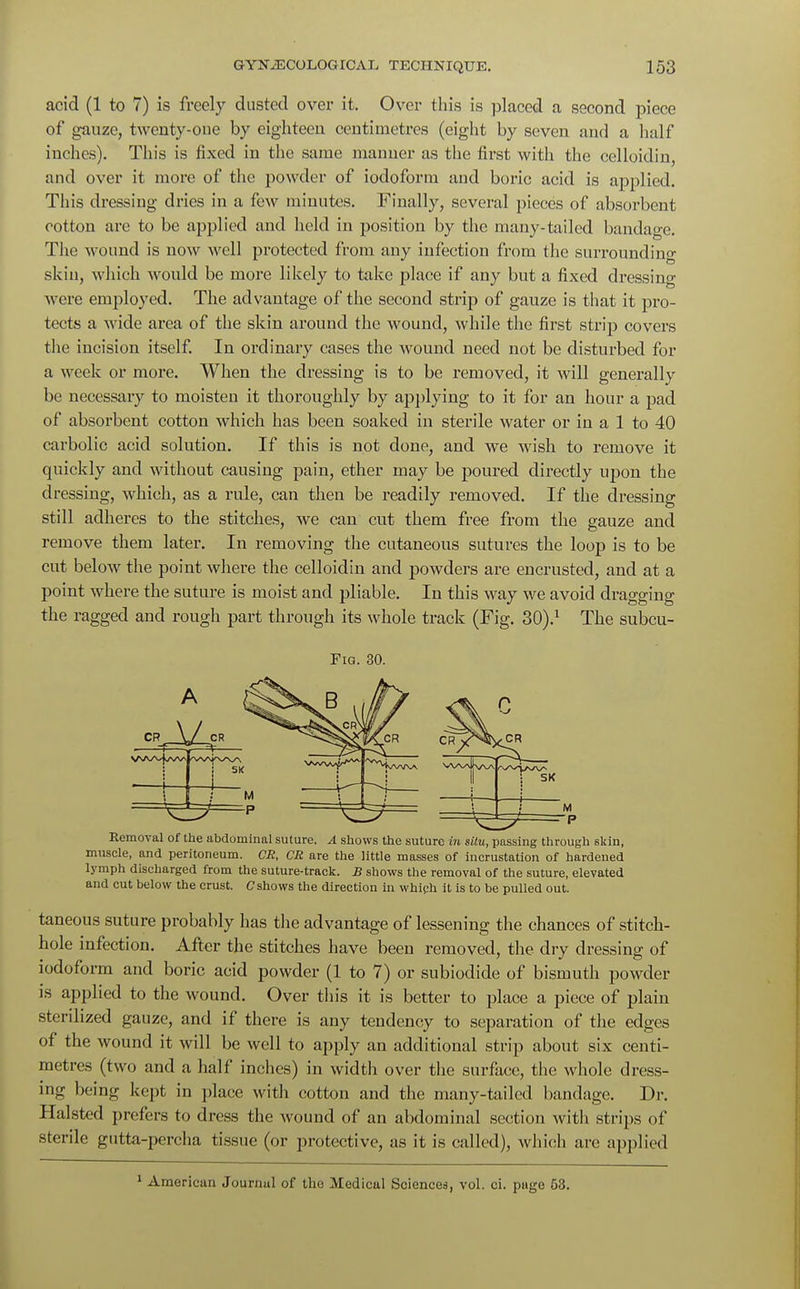 acid (1 to 7) is freely dusted over it. Over this is placed a second piece of gauze, twenty-one by eighteen centimetres (eight by seven and a half inches). This is fixed in the same manner as the first with the celloidin, and over it more of the powder of iodoform and boric acid is applied. This dressing dries in a few minutes. Finally, several pieces of absorbent cotton are to be applied and held in position by the many-tailed bandage. The wound is now well protected from any infection from the surrounding skin, which would be more likely to take place if any but a fixed dressing were employed. The advantage of the second strip of gauze is that it pro- tects a wide area of the skin around the wound, while the first strip covers the incision itself. In ordinary cases the wound need not be disturbed for a week or more. When the dressing is to be removed, it will generally be necessary to moisten it thoroughly by applying to it for an hour a pad of absorbent cotton which has been soaked in sterile water or in a 1 to 40 carbolic acid solution. If this is not done, and we wish to remove it quickly and without causing pain, ether may be poured directly upon the dressing, which, as a rule, can then be readily removed. If the dressing still adheres to the stitches, we can cut them free from the gauze and remove them later. In removing the cutaneous sutures the loop is to be cut below the point where the celloidin and powders are encrusted, and at a point where the suture is moist and pliable. In this way we avoid dragging the ragged and rough part through its whole track (Fig. 30).1 The subcu- Fiq. 30. Removal of the abdominal suture. A shows the suture in situ, passing through skin, muscle, and peritoneum. CR, CR are the little masses of incrustation of hardened lymph discharged from the suture-track. B shows the removal of the suture, elevated and cut below the crust. C shows the direction in which it is to be pulled out. taneous suture probably has the advantage of lessening the chances of stitch- hole infection. After the stitches have been removed, the dry dressing; of iodoform and boric acid powder (1 to 7) or subiodide of bismuth powder is applied to the wound. Over this it is better to place a piece of plain sterilized gauze, and if there is any tendency to separation of the edges of the wound it will be well to apply an additional strip about six centi- metres (two and a half inches) in width over the surface, the whole dress- ing being kept in place with cotton and the many-tailed bandage. Dr. Halsted prefers to dress the wound of an abdominal section with strips of sterile gutta-percha tissue (or protective, as it is called), which are applied 1 American Journul of tho Medical Sciences, vol. ci. puge 53.