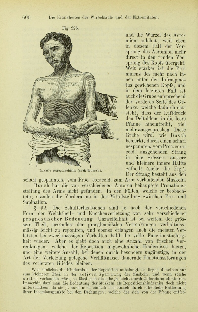 Fig. 225. und die Wurzel des Acro- mion anlehnt, weil eben in diesem Fall der Vor- sprung des Acromion mehr direct in den runden Vor- sprung des Kopfs übergeht. Weit stärker ist die Pro- minenz des mehr nach in- nen unter den Infraspina- tus gewichenen Kopfs, und in dem letzteren Fall ist auch die Grube entsprechend der vorderen Seite des Ge- lenks, welche dadurch ent- steht, dass der Luftdruck den Deltoideus in die leere Pfanne hineintreibt, viel mehr ausgesprochen. Diese Grube wird, wie Busch bemerkt, durch einen scharf gespannten, vom Proc. cora- coid. ausgehenden Strang in eine grössere äussere und kleinere innere Hälfte getheilt (siehe die Fig.). Der Strang besteht aus den scharf gespannten, vom Proc. coraeoid. zum Arm verlaufenden Muskeln. Busch hat die von verschiedenen Autoren behauptete Pronations- stellung des Arms nicht gefunden. In den Fällen, welche er beobach- tete, standen die Vorderarme in der Mittelstellung zwischen Pro- und Supination. §. 92. Die Schulterluxationen sind je nach der verschiedenen Form der Weichtheil- und Knochenverletzung von sehr verschiedener prognostischer Bedeutung Unzweifelhaft ist bei weitem der grös- sere Theil, besonders der praeglenoidalen Verrenkungen verhältniss- mässig leicht zu reponiren, und ebenso erlangen auch die meisten Ver- letzton bei zweckmässigem Verhalten bald die volle Functionstüchtig- keit wieder. Aber es giebt doch auch eine Anzahl von frischen Ver- renkungen, welche der Reposition ungewöhnliche Hindernisse bieten, und eine weitere Anzahl, bei denen durch besonders ungünstige, in der Art der Verletzung gelegene Verhältnisse, dauernde Functionsstörnngen des verletzten Gliedes bleiben. Was zunächst die Hindernisse der Reposition anbelangt, so liegen dieselben nur zum kleineren Theil in der activen Spannung der Muskeln, und wenn solche wirklich vorhanden wäre, so lässt sich dieselbe ja leicht durch Chloroform climiniren. Immerhin darf man die Bedeutung der Muskeln als Repositionshinderniss doch nicht unterschätzen, da sie ja auch noch einfach mechanisch durch erhebliche Entfernung ihrer Insertionspunkte bei den Drehungen, welche der sich von der Pfanne entfer-