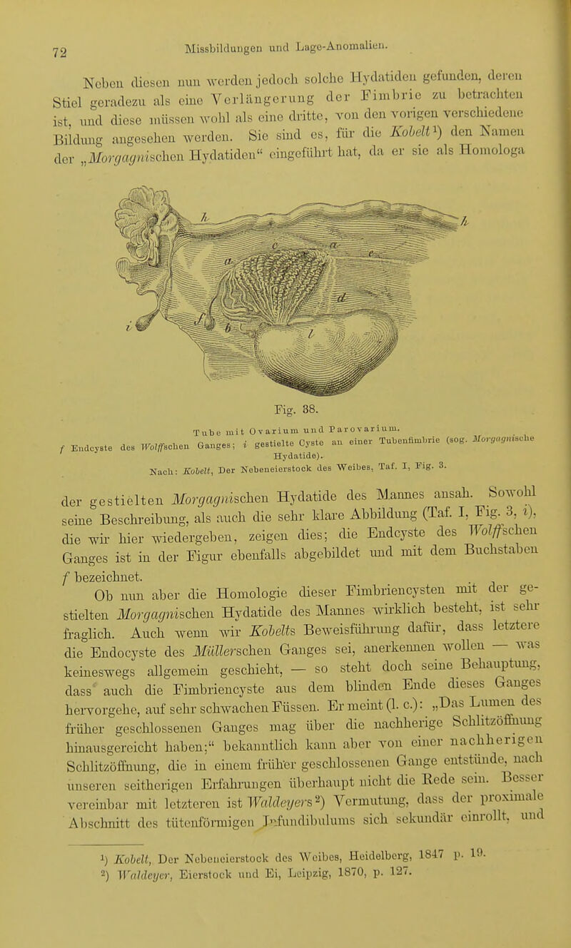 72 Neben diesen nun werden jedoch solche Hydatiden gefunden, deren Stiel geradezu als eine Verlängerung der Fimbrie zu betrachten ist und diese müssen wohl als eine dritte, von den vorigen verschiedene Bildung angesehen werden. Sie sind es, für die Kobeln) den Namen der Moralischen Hydatiden« eingeführt bat, da er sie als Homologa Fig. 38. Tube mit Ovarium und Parovarium. f Endcyste des «eben Ganges; i gestielte Cyste au einer Tubennmbrie (sog. Morgagni Hydatide). Nach: Kübelt, Der Nebeneierstock des Weibes, Taf. I, Fig. 3. der gestielten Morgagnischen Hydatide des Mannes ansah. Sowohl seine Beschreibimg, als auch die sehr klare Abbildung (Taf. I, Fig. 3 t), die wh- hier wiedergeben, zeigen dies; die Endcyste des Tüschen Ganges ist in der Figur ebenfalls abgebildet und mit dem Buchstaben f bezeichnet. Ob mm aber die Homologie dieser Fimbrien Cysten mit der ge- stielten Morgagnischen Hydatide des Mannes wirklich besteht, ist sehr fraglich. Auch wenn wir Kobelts Beweisführimg dafür, dass letztere die Endocyste des Märschen Ganges sei, anerkennen wollen — was keineswegs allgemein geschieht, - so steht doch seine Behauptung, dass auch die Fimbriencyste aus dem blinden Ende dieses Ganges hervorgehe, auf sehr schwachen Füssen. Er meint (1. c): „Das Lumen des früher geschlossenen Ganges mag über die nachherige Schlitzöffiiung hinausgereicht haben; bekanntlich kann aber von einer nachherigen Schlitzöffnimg, die in einem früher geschlossenen Gange entstünde, nach unseren seitherigen Erfahrungen überhaupt nicht die Eede sem. Besser vereinbar mit letzteren ist Waläeyers *) Vermutung, dass der proximale Abschnitt des tütenförmigen fefundihulums sich sekundär einrollt, und 1) Kabelt, Der Nebeueierstock des Weibes, Heidelberg, 1847 p. 1».