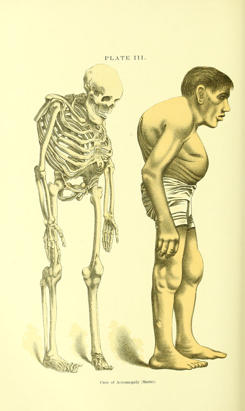 PLATE III. Case of Acromegaly (Marie).