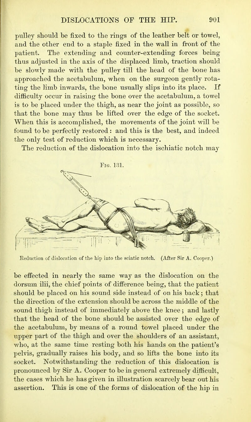 pulley should be fixed to the rings of the leather belt or towel, and the other end to a staple fixed in the wall in front of the patient. The extending and counter-extending forces being thus adjusted in the axis of the displaced limb, traction should be slowly made with the pulley till the head of the bone has approached the acetabulum, when on the surgeon gently rota- ting the limb inwards, the bone usually slips into its place. If difficulty occur in raising the bone over the acetabulum, a towel is to be placed under the thigh, as near the joint as possible, so that the bone may thus be lifted over the edge of the socket. When this is accomplished, the movements of the joint will be found to be perfectly restored: and this is the best, and indeed the only test of reduction which is necessary. The reduction ©f the dislocation into the ischiatic notch may Reduction of dislocation of the hip into the sciatic notch. (After Sir A. Cooper.) be effected in nearly the same way as the dislocation on the dorsum ilii, the chief points of difference being, that the patient should be placed on his sound side instead of on his back; that the direction of the extension should be across the middle of the sound thigh instead of immediately above the knee; and lastly that the head of the bone should be assisted over the edge of the acetabulum, by means of a round towel placed under the upper part of the thigh and over the shoulders of an assistant, who, at the same time resting both his hands on the patient's pelvis, gradually raises his body, and so lifts the bone into its socket. Notwithstanding the reduction of this dislocation is pronounced by Sir A. Cooper to be in general extremely difficult, the cases which he has given in illustration scarcely bear out his assertion. This is one of the forms of dislocation of the hip in Fig. l.^l. /