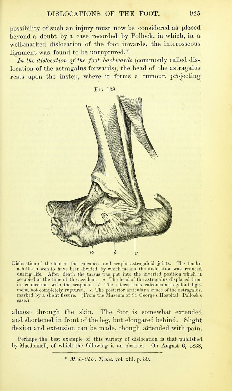 possibility of such, an injury must now be considered as placed beyond a doubt by a case recorded by Pollock, in which, in a well-marked dislocation of the foot inwards, the interosseous ligament was found to be unruptured.* In the dislocation of the foot backwards (commonly called dis- location of the astragalus forwards), the head of the astragalus rests upon the instep, where it forms a tumour, projecting Fig. 138. Dislocation of the foot at the calcaneo- and scapbo-astragaloid joints. The teudo- achillis is seen to have been divided, by which means the dislocation was reduced during life. After death the tarsus was put into the inverted position which it occupied at the time of the accident, a. The head of the astragalus displaced from its connection with the scaphoid, h. The interosseous calcaneo-astragaloid liga- ment, not completely rviptured. c. The posterior articular surface of the astragalus, marked by a slight fissure. (From the Museum of St. George's Hospital. Pollock's case.) almost through the skin. The foot is somewhat extended and shortened in front of the leg, but elongated behind. Slight flexion and extension can be made, though attended with pain. Perhaps the best example of this variety of dislocation is that published by Macdonnell, of which the following is an abstract. On August 6, 1838, * Med.-Chir. Truns. vol. xlii. p. 39.