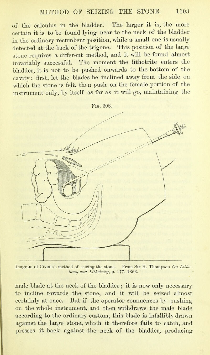 of the calculus in the bladder. The larger it is, the more certain it is to be found lying near to the neck of the bladder in the ordinary recumbent position, while a small one is usually detected at the back of the trigone. This position of the large stone requires a different method, and it will be found almost invariably successful. The moment the lithotrite enters the bladder, it is not to be pushed onwards to the bottom of the cavity: first, let the blades be inclined away from the side on which the stone is felt, then push on the female portion of the instrument only, by itself as far as it will go, maintaining the Fig. 308. Diagram of Civiale's method of seizing the stone. From Sir H. Thompson On Litho- tomy and Litkotrity,'^. 177. 1863. male blade at the neck of the bladder; it is now only necessary to incline towards the stone, and it will be seized almost certainly at once. But if the operator commences by pushing on the whole instrument, and then withdraws the male blade according to the ordinary custom, this blade is infallibly drawn against the large stone, which it therefore fails to catch, and presses it back against the neck of the bladder, producing