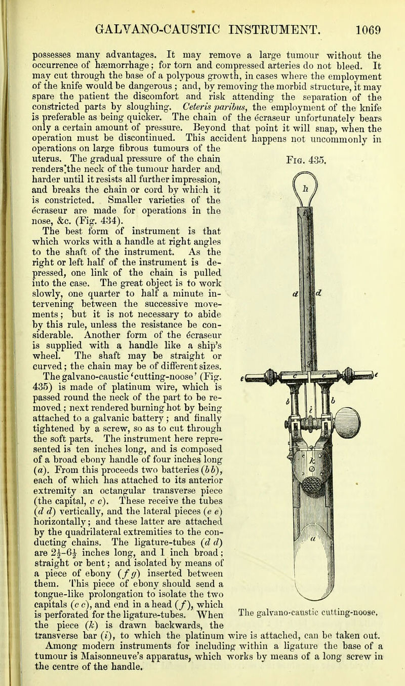 Fig. 43o. possesses many advantages. It may remove a large tumour without the occurrence of haemorrhage; for torn and compressed arteries do not bleed. It may cut through the base of a polypous growth, in cases where the employment of the knife would be dangerous ; and, by removing the morbid structure, it may spare the patient the discomfort and risk attending the separation of the constricted parts by sloughing. Ceteris paribus, the employment of the knife is preferable as being quicker. The chain of the ecraseur unfortunately bears only a certain amount of pressure. Beyond that point it will snap, when the operation must be discontinued. This accident happens not uncommonly in operations on large fibrous tumours of the uterus. The gradual pressure of the chain renders'the neck of the tumour harder and harder until it resists all further impression, and breaks the chain or cord by which it is constricted. Smaller varieties of the ecraseur are made for operations in the nose, &c. (Fig. 4-ii). The best form of instrument is that which works with a handle at right angles to the shaft of the instrument. As the right or left half of the instrument is de- pressed, one link of the chain is pulled into the case. The great object is to work slowly, one quarter to half a minute in- tervening between the successive move- ments ; but it is not necessary to abide by this rule, unless the resistance be con- siderable. Another form of the Ecraseur is supplied with a handle like a ship's wheel. The shaft may be straight or curved; the chain may be of different sizes. Thegalvano-caustic 'cutting-noose' (Fig. 435) is made of platinum wire, which is passed round the neck of the part to be re- moved ; next rendered burning hot by being attached to a galvanic battery; and finally tightened by a screw, so as to cut through the soft parts. The instrument here repre- sented is ten inches long, and is composed of a broad ebony handle of foui' inches long (a). From this proceeds two batteries (bb), each of which has attached to its anterior extremity an octangular transverse piece (the capital, c c). These receive the tubes (d d) vertically, and the lateral pieces (e e) horizontally; and these latter are attached by the quadrilateral extremities to the con- ducting chains. The ligature-tubes {d d) are 2^-6^ inches long, and 1 inch broad; straight or bent; and isolated by means of a piece of ebony {f (f) inserted between them. This piece of ebony should send a tongue-like prolongation to isolate the two capitals (c e), and end in ahead (/), which is perforated for the ligature-tubes. When the piece (Ji) is drawn backwards, the transverse bar («), to which the platinum wire is attached, can be taken out. Among modern instruments for including within a ligature the base of a tumour is Maisonneuve's apparatus, which works by means of a long screw in the centre of the handle. The galvano-caxistic cutting-noose.