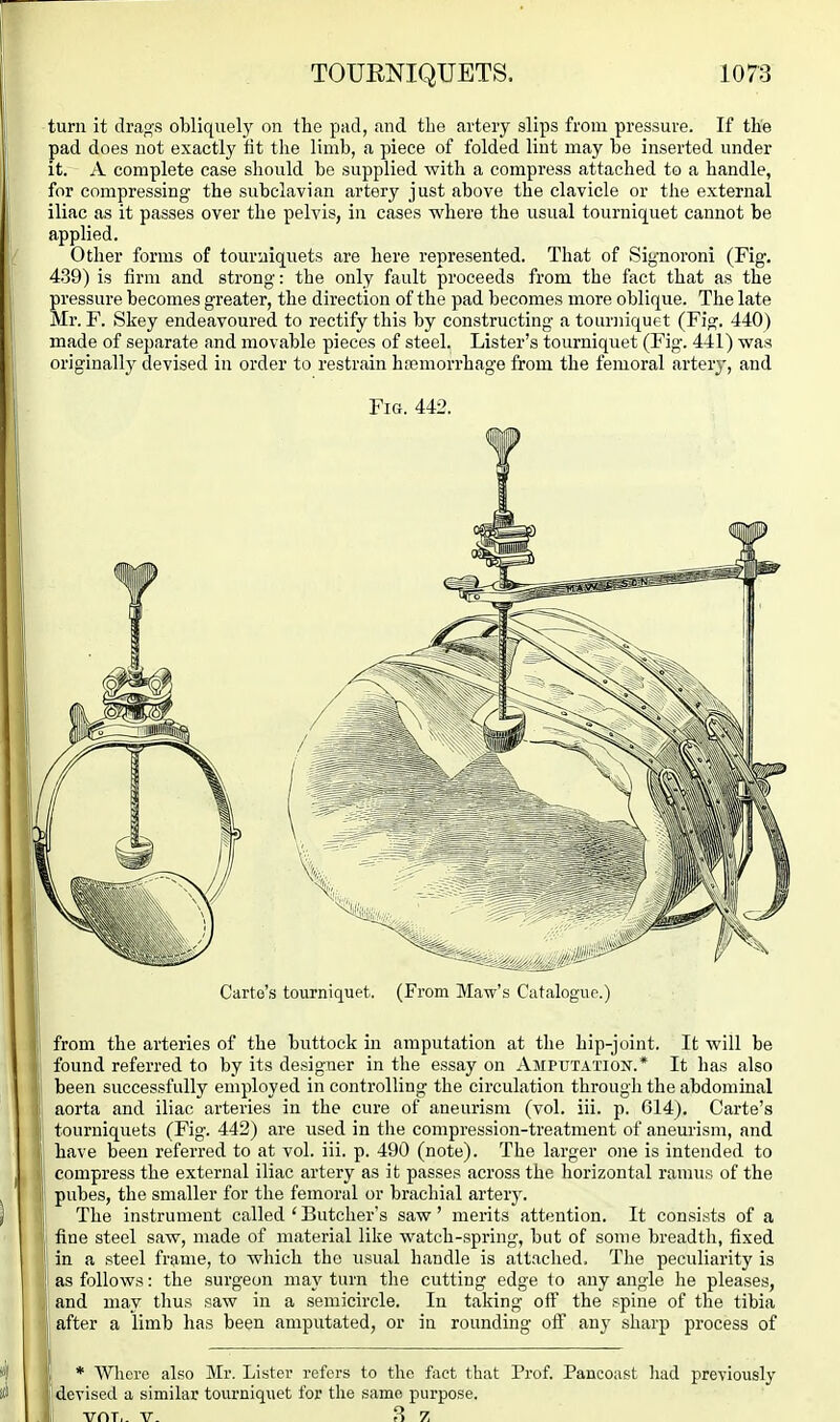 turn it drags obliquely on the pad, and the artery slips from pressure. If the pad does not exactly fit the limb, a piece of folded lint may be inserted under it. A complete case should be supplied with a compress attached to a handle, for compressing; the subclavian artery just above the clavicle or the external iliac as it passes over the pelvis, in cases where the usual tourniquet cannot be applied. Other forms of tourniquets are here represented. That of Signoroni (Fig. 439) is firm and strong: the only fault proceeds from the fact that as the pressure becomes greater, the direction of the pad becomes more oblique. The late Mr. F. Skey endeavoured to rectify this by constructing a tourniquet (Fig. 440) made of separate and movable pieces of steel. Lister's tourniquet (Fig. 441) was originally devised in order to restrain hsemorrhage from the femoral arterj-, and Fig. 442. ' from the arteries of the buttock in amputation at tlie hip-joint. It will be I found referred to by its designer in the essay on Amputation.* It has also been successfully employed in controlling the circulation through the abdominal i aorta and iliac arteries in the cure of aneurism (vol. iii. p. 614), Carte's \ tourniquets (Fig. 442) are used in the compression-treatment of aneurism, and i have been referred to at vol. iii. p. 490 (note). The larger one is intended to compress the external iliac artery as it passes across the horizontal ramus of the j pubes, the smaller for the femoral or brachial arter}^ The instrument called ' Butcher's saw' merits attention. It consists of a ' fine steel saw, made of material like watch-spring, but of some breadth, fixed 1 in a steel frame, to which the usual handle is attached. The peculiarity is !' as follows: the surgeon may turn tlie cutting edge to any angle he pleases, ! and may thus saw in a semicircle. In taking off the spine of the tibia j after a limb has been amputated, or in rounding off any sharp process of '! * Where also Mr. Lister refers to the fact that Prof. Pancoast liad previously : devised a similar tourniquet for the same purpose. I ill VfIT,. V. 8 7 _