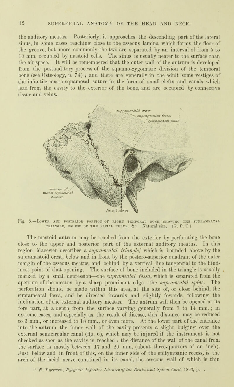 the auditory meatus. Posteriorly, it approaches the descending part of the lateral sinus, in some cases reaching close to the osseous lamina which forms the floor of the groove, but more commonly the two are separated by an interval of from 5 to 10 mm. occupied by mastoid cells. The sinus is usually nearer to the surface than the air-space. It will be remembered that the outer wall of the antrum is developed from the postauditory process of the squamo-zygomatic division of the temporal bone (see Osteology, p. 74) ; and there are generally in the adult some vestiges of the infantile masto-squamosal suture in the form of small clefts and canals which lead from the cavity to the exterior of the bone, and are occupied by connective tissue and veins. remains of mcisi sfxprcunyxstoicL n-csb fctcuxL Fig. 8.—Lower and posterior portion op right temporal bone, showing the supraheatal triangle, course op the pacial nerve, &c. Natural size. (Gr. 1). T.) The mastoid antrum may be reached from the exterior by perforating the bone close to the upper and posterior part of the external auditory meatus. In this region Mace wen describes a suprameatal triangle' which is bounded above by the supramastoid crest, below and in front by the postero-superior quadrant of the outer margin of the osseous meatus, and behind by a vertical line tangential to the hind¬ most point of that opening. The surface of bone included in the triangle is usually marked by a small depression—the suprameatal fossa, which is separated from the aperture of the meatus by a sharp prominent edge—the suprameatal spine. The perforation should be made within this area, at the site of, or close behind, the suprameatal fossa, and be directed inwards and slightly towards, following the inclination of the external auditory meatus. The antrum will then be opened at its fore part, at a depth from the surface varying generally from 7 to 14 mm. ; in extreme cases, and especially as the result of disease, this distance may be reduced to 3 mm., or increased to 18 mm., or even more. At the lower part of the entrance into the antrum the inner wall of the cavity presents a slight bulging over the external semicircular canal (fig. 6), which may be injured if the instrument is not checked as soon as the cavity is reached : the distance of the wall of the canal from the surface is mostly between 17 and 20 mm. (about three-quarters of an inch). Just below and in front of this, on the inner side of the epitympanic recess, is the arch of the facial nerve contained in its canal, the osseous wall of which is thin 1 W. Macewen, Pyogenic Infective Diseases of the Brain and Spinal Cord, 1893, p. .