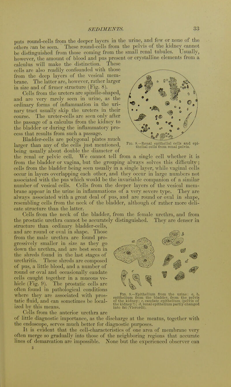 Fig. 8.—Renal epithelial cells and thelial cells from renal pelvis. epi- puts round-cells from the deeper layers in the urine, and few or none of the others can be seen. These round-cells from the pelvis of the kidney cannot be distinguished from those coming from the small renal tubules. Usually, however, the amount of blood and pus present or crystalline elements from a calculus will make the distinction. These cells are also readily confounded with those from the deep layers of the vesical mem- brane. The latter are, however, rather larger in size and of firmer structure (Fig. 8). Cells from the ureters are spindle-shaped, and are very rarely seen in urine, as the ordinary forms of inflammation in the uri- nary tract usually skip the ureters in their course. The ureter-cells are seen only after the passage of a calculus from the kidney to the bladder or during the inflammatory pro- cess that results from such a passage. Bladder-cells are polygonal plates much larger than any of the cells just mentioned, being usually about double the diameter of the renal or pelvic cell. We cannot tell from a single cell whether it is from the bladder or vagina, but the grouping always solves this difficulty; cells from the bladder being seen usually in a single layer, while vaginal cells occur in layers overlapping each other, and they occur in large numbers not associated with the pus which would be the invariable companion of a similar number of vesical cells. Cells from the deeper layers of the vesical mem- brane appear in the urine in inflammations of a very severe type. They are always associated with a great deal of pus, and are round or oval in shape, resembling cells from the neck of the bladder, although of rather more deli- cate structure than the latter. Cells from the neck of the bladder, from the female urethra, and from the prostatic urethra cannot be accurately distinguished. They are denser in structure than ordinary bladder-cells, and are round or oval in shape. Those from the male urethra are found pro- gressively smaller in size as they go down the urethra, and are best seen in the shreds found in the last stages of urethritis. These shreds are composed of pus, a little blood, and a number of round or oval and occasionally caudate cells caught together in a mucous ve- hicle (Fig. 9). The prostatic cells are often found in pathological conditions where they are associated with pros- tatic fluid, and can sometimes be local- ized by this means. Tells from the anterior urethra are of little diagnostic importance, as the dischai'ge at the meatus, together with the endoscope, serves much better for diagnostic purposes. It is evident that the cell-characteristics of one area of membrane very often merge so gradually into those of the neighboring regions that accurate lines of demarcation are impossible. None but the experienced observer can Fig. 9.—Epithelium from the urine: a, b, epithelium from the bladder, from the pelvis 01 the kidney; C, caudate epithelium (pelvis of the kidney ?); d, renal epithelium partly changed into fat (vierordt).