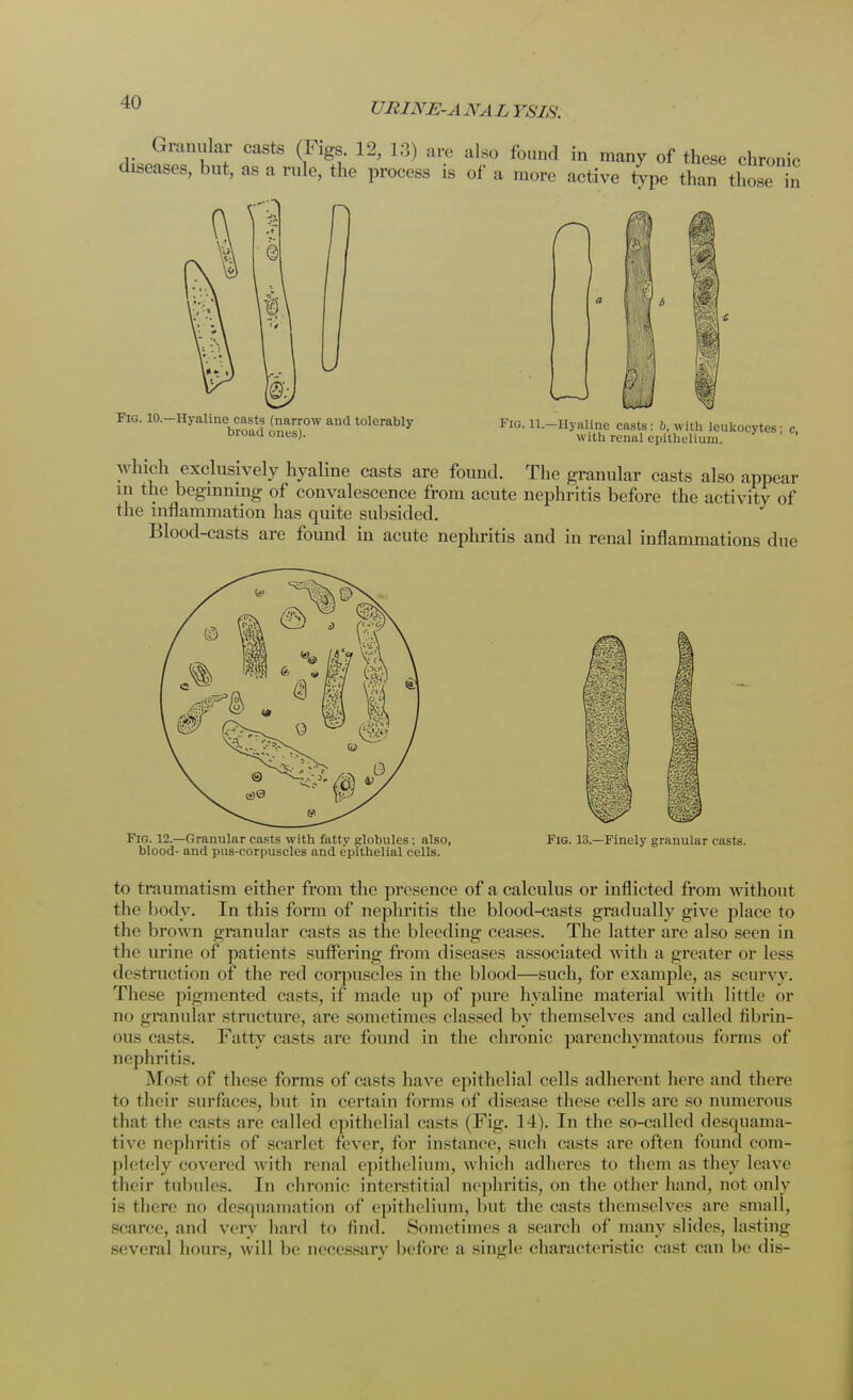Granular casts (Figs. 12, 13) are also found in many of these chronic diseases, but, as a rule, the process is of a more active type than those in D Fig. 10.—Hyaline casts (narrow and tolerably broad ones). Fig. 11.—Hyaline casts: b, with leukocytes; c, with renal epithelium. which exclusively hyaline casts are found. The granular casts also appear m the beginning of convalescence from acute nephritis before the activity of the inflammation has quite subsided. Blood-casts are found in acute nephritis and in renal inflammations due Fig. 12.—Granular casts with fatty globules; also, blood- and pus-corpuscles and epithelial cells. Fig. 13.—Finely granular casts. to traumatism either from the presence of a calculus or inflicted from without the body. In this form of nephritis the blood-casts gradually give place to the brown granular casts as the bleeding ceases. The latter are also seen in the urine of patients suffering from diseases associated with a greater or Less destruction of the red corpuscles in the blood—such, for example, as scurvy. These pigmented casts, if made up of pure hyaline material with little or no granular structure, are sometimes classed by themselves and called fibrin- oid c;t>ts. Fatty easts are found in the chronic parenchymatous forms of nephritis. Most of these forms of casts have epithelial cells adherent here and there to their surfaces, but in certain forms of disease these cells are so numerous that the ea^ts are called epithelial casts (Fig. 14). In the so-called desquama- tive nephritis of scarlet fever, for instance, such casts are often found com- pletely covered w ith renal epithelium, which adheres to them as they leave their tubules. In chronic interstitial nephritis, on the other hand, not only is there no desquamation of epithelium, hut the casts themselves are small, scarce, and very hard to find. Sometimes a search of many slides, lasting several hours, will be necessary before a single characteristic cast can be dis-