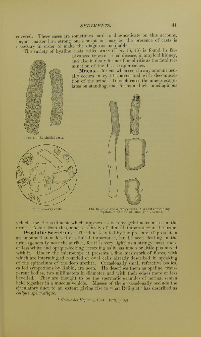 covered. These cases are sometimes hard to diagnosticate on this account, for, QO mutter how strong one's suspicion may be, the presence of casts is necessary in order to make the diagnosis justifiable. The'variety of hyaline casts called waxy (Figs. L5, 16) is found in far- advanced types of renal disease, in amyloid kidney, and also in many forms of nephritis as the fatal ter- mination of the disease approaches. MUCUS.—Mucus when seen in any amount usu- ally occurs in cystitis associated with decomposi- tion of the urine. In such cases the mucus coagu- a thick mucilaginous lates on standing, and forms Fig. 14.—Epithelial casts. Fig. 15.—Waxy casts. Fig. 16.—a, c, and d, waxy casts ; 6, a cast containing crystals of oxalate of lime (von Jaksch). vehicle for the sediment which appears as a ropy gelatinous mass in the urine. Aside from this, mucus is rarely of clinical importance in the urine. Prostatic Secretion.—The fluid secreted by the prostate, if present in an amount that makes it of clinical importance, can be seen floating in the urine (generally near the surface, for it is very light) as a stringy mass, more or less white and opaque-looking according as it has much or little pus mixed with it. Under the microscope it presents a fine meshwork of fibres, with which are intermingled rounded or oval cells already described in speaking of the epithelium of the dee]) urethra. Occasionally small refractive bodies, called sympexions by Robin, are seen. He describes them as opaline, trans- parent bodies, two millimeters in diameter, and w ith their edges more or less bevelled. They are thought to he the spermatic granules of normal semen held together in a mucous vehicle. Masses of them occasionally occlude the ejaculatory duct to an extent giving rise to what Reliquet1 has described as colique spermatique. 1 Gazette des Hdpitaux, 1874 ; 1879, p. 891.