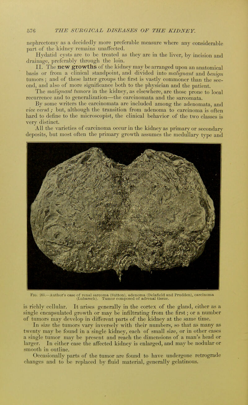 nephrectomy as a decidedly more preferable measure where any considerable part of the kidney remains unaffected. Hydatid cysts are to be treated as they are in the liver, by incision and drainage, preferably through the loin. II. The new growths of the kidney may be arranged upon an anatomical basis or from a clinical standpoint, and divided into malignant and benign tumors; and of these latter groups the first is vastly commoner than the sec- ond, and also of more significance both to the physician and the patient. The malignant tumors in the kidney, as elsewhere, are those prone to local recurrence and to generalization—the carcinomata and the sarcomata. By some writers the carcinomata are included among the adenomata, and vice versa; but, although the transition from adenoma to carcinoma is often hard to define to the microscopist, the clinical behavior of the two classes is very distinct. All the varieties of carcinoma occur in the kidney as primary or secondary deposits, but most often the primary growth assumes the medullary type and Fig. 205.—Author's case of renal sarcoma (Sutton), adenoma (Delafield and Prudden), carcinoma (Lubarsch). Tumor composed of adrenal tissue. is richly cellular. It arises generally in the cortex of the gland, either as a single encapsulated growth or may be infiltrating from the first; or a number of tumors may develop in different parts of the kidney at the same time. In size the tumors vary inversely with their numbers, so that as many as twenty may be found in a single kidney, each of small size, or in other cases a -ingle tumor may be present and reach the dimensions of a man's head or larger. In either case the affected kidney is enlarged, and may be nodular or smooth in outline. Occasionally parts of the tumor are found to have undergone retrograde changes and to be replaced by fluid material, generally gelatinous.