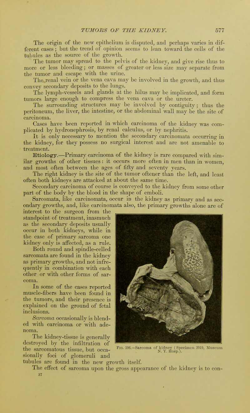 The origin of the new epithelium is disputed, and perhaps varies in dif- ferent cases; but the trend of opinion seems to lean toward the cells of the tubules as the source of the growth. The tumor may spread to the pelvis of the kidney, and give rise thus to more or less bleeding; or masses of greater or less size may separate from the tumor and escape with the urine. The renal vein or the vena cava may be involved in the growth, and thus convey secondary deposits to the lungs. The lymph-vessels and glands at the hilus may be implicated, and form tumors large enough to compress the vena cava or the ureter. The surrounding structures may be involved by contiguity; thus the peritoneum, the liver, the intestine, or the abdominal wall may be the site of carcinoma. Cases have been reported in which carcinoma of the kidney was corn- plicated by hydronephrosis, by renal calculus, or by nephritis. It is only necessary to mention the secondary carcinomata occurring in the kidney, for they possess no surgical interest and are not amenable to treatment. Etiology.—Primary carcinoma of the kidney is rare compared with sim- ilar growths of other tissues : it occurs more often in men than in women, and most often between the ages of fifty and seventy years. The right kidney is the site of the tumor oftener than the left, and least often both kidneys are attacked at about the same time. Secondary carcinoma of course is conveyed to the kidney from some other part of the body by the blood in the shape of emboli. Sarcomata, like carcinomata, occur in the kidney as primary and as sec- ondary growths, and, like carcinomata also, the primary growths alone are of interest to the surgeon from the standpoint of treatment, inasmuch as the secondary deposits usually occur in both kidneys, while in the case of primary sarcoma one kidney only is affected, as a rule. Both round and spindle-celled sarcomata are found in the kidney as primary growths, and not infre- quently in combination with each other or with other forms of sar- coma. In some of the cases reported muscle-fibers have been found in the tumors, and their presence is explained on the ground of fetal inclusions. Sarcoma occasionally is blend- ed with carcinoma or with ade- noma. The kidney-tissue is generally destroyed by the infiltration of the sarcomatous tissue, but occa- Fl0' 20G -Sarcoma of^e^|5fclmen 2019, Museum sionally foci of glomeruli and tubules are found in the new growth itself. The effect of sarcoma upon the gross appearance of the kidney is to con- 37