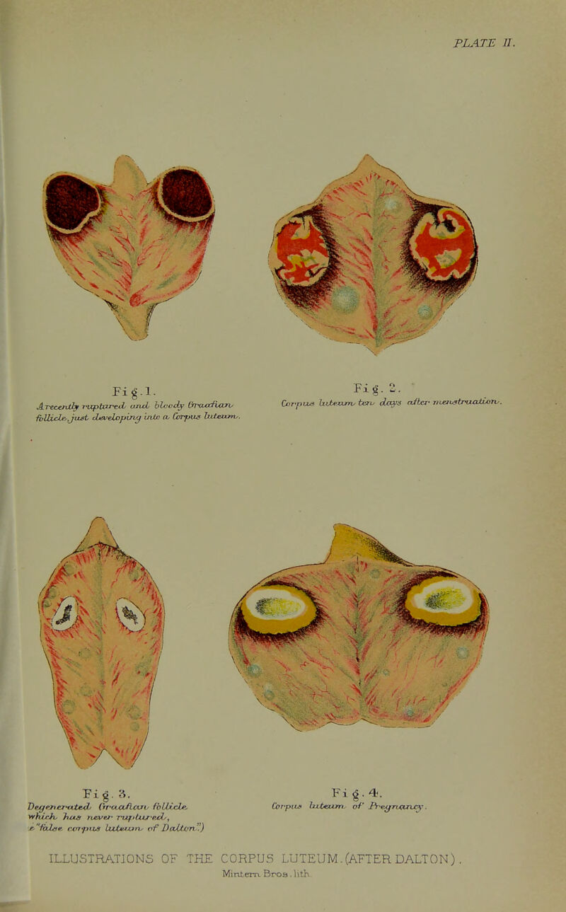 PLATE 11. Pig.?.. Fig-4^- whirjv hus rixvu- rufiUvKcly, j^/ai<»e cxfj-pus Luttujjiiy of Dalttm'!) ILLUSTRATIONS OF THE CORPUS LUTEUM. (AFTER DALTON) Mintem. Broa. hth