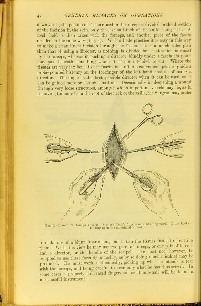 dowmvards, the portion of fascia raised in the forceps is divided in the direction of the incision in the skin, only the last lialf-inch of the knife being used. A fresh, hold is then taken with the forceps, and another piece of the fascia divided in the same way (Fig. 6). With a little practice it is easy in this way to make a clean linear incision through the fascia. It is a much safer plan than that of usuig a director, as nothing is divided but that which is raised by the forceps, whereas in pushing a director blindly under a fascia its point may pass beneath something which it is not intended to cut. Where the tissues are very lax beneath the fascia, it is often a convenient plan to guide a probe-pointed bistoury on the forefinger of the left hand, instead of using a director. The finger is the best possible director when it can be used, as it can be guided more or less by sensation. Occasionally in deepening a wound through very loose structures, amongst which important vessels may lie, as in removing tumours from the root of the neck or the axilla, the Surgeon may prefer to make use of a blunt instrument, and to tear the tissues instead of cutting them. With this view he may use two pairs of forceps, or one pair of forceps and a director, or the handle of the scalpel. He must not, however, be tempted to use these forcibly or rashly, as by so doing much mischief may bo produced. He must work methodically, picking up what he intends to tear with the forceps, and being careful to tear only what he has thus seized. In some cases a properly cultivated finger-nail or thumb-nail wiU be found a most useftd instrument.