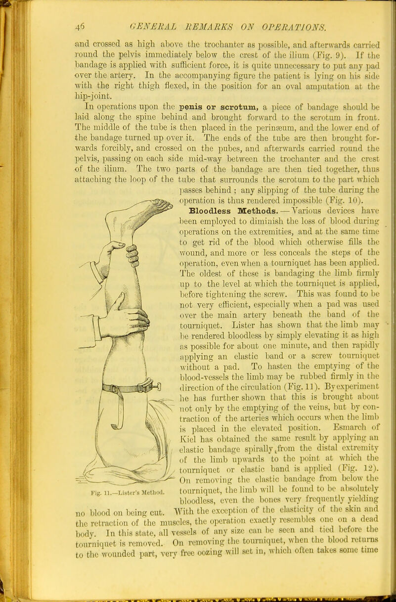 and crossed as higli above the trochanter as possible, and afterwards carried ]-ound the pelvis immediately below the crest of the ilium (Fig. 9). If the bandage is applied with sufficient force, it is quite unnecessary to put any pad over the artery. In the accompanying figure the patient is lying on his side ■with the right thigh flexed, in the position for an oval amputation at the hip-joint. In operations upon the penis or scrotum, a piece of bandage should be laid along the spine behind and brought forward to the scrotum in front. The middle of the tube is then placed in the perinteum, and the lower end of the bandage turned up over it. The ends of the tube are then brought for- wards forcibly, and crossed on the pubes, and afterwards carried round the pelvis, passing on each side mid-way between the trochanter and the crest of the ilium. The two parts of the bandage are then tied together, thus attaching the loop of the tube that surrounds the scrotum to the part which ])asses behind ; any slipping of the tube during the operation is thus rendered impossible (Fig. 10). Bloodless Methods.—Various devices have been employed to diminish the loss of blood dm'ing operations on the extremities, and at the same time to get rid of the blood which otherwise fills the wound, and more or less conceals the steps of the operation, even when a tourniquet has been apphed. The oldest of these is bandaging the limb firmly up to the level at which the tourniquet is applied, before tightening the screw. This was found to be not very efficient, especially when a pad was used over the main artery beneath the band of the tourniquet. Lister has shown that the limb may lie rendered bloodless by simply elevating it as high as possible for about one minute, and then rapidly applying an elastic band or a screw tourniquet without a pad. To hasten the emptying of the blood-vessels the limb may be rubbed firmly in the direction of the circulation (Fig. 11). By experiment he has further shown that this is brought about not only by the emptying of the veins, but by con- traction of the arteries which occurs when the hmb is placed in the elevated position. Esmarch of Kiel has obtained the same result by applying an elastic bandage spirally,from the distal extremity of the limb upwards to the point at which the tourniquet or elastic band is applied (Fig. 12). On removing the clastic bandage fi-om below the Fig. ii.-Listcr-s Method. toumiquct, the limb will be found to be absolutely bloodless, even the bones very frequently yieldnig no blood on being cut. With the exception of the elasticity of the skin and the retraction of the muscles, the operation exactly resembles one on a dead body. In this state, all vessels of any size can be seen and tied before the tourniquet is removed. On removing the tourniquet, when the blood returns to the wounded part, very free oozing will set in, which often takes some tmie