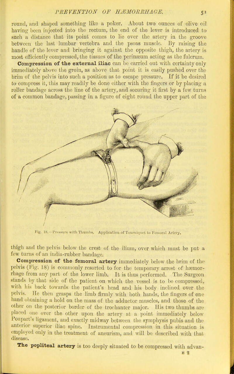 round, aud shaped something like a poker. About two ounces of olive oil having been injected into the rectum, the end of the lever is introduced to such a distance that its point comes to lie over the artery in the groove between the last lumbar vertebra and the psoas muscle. By raising the handle of the lever and bringing it against the opposite thigh, the artery is most efficiently compressed, the tissues of the periuEBum acting as thefulcrmn. Compression of the external iliac can be carried out with certainty only immediately above the groin, as above that point it is easily pushed over the brim of the pelvis into such a position as to escape pressm'e. If it be desired to compress it, this may readily be done either with the fingers or by placing a roller bandage across the line of the artery, and securing it first by a few turns of a common bandage, passing in a figure of eight round the upper part of the Fig. 18.— t'lvssure with Tliuinl)S. Application of Touniitiuct to Femoral Artery. thigh and the pelvis below the crest of the ilium, over which must be put a few turns of an india-rubber bandage. Compression of the femoral artery immediately below the brim of the pelvis (Fig. 18) is commonly resorted to for the temporary arrest of haemor- rhage from any part of the lower limb. It is thus performed. Tlie Sm-geon stands l)y that side of the patient on which the vessel is to be compressed, with his back towards the patient's head and his body inclined over the pelvis. FTe then grasps the limb firmly with both hands, the fingers of one hand ol)bainiug a hold on the mass of the adductor muscles, and those of the other on the posterior border of the trochanter major. His two thumbs are placed one over the other upon the artery at a point immediately below Poiipart's ligament, and exactly midway between the symphysis pubis and the anterior superior iliac spine. Instrumental compression in this situation is employed only in the treatment of anem-ism, aud will be described with that disease. The popliteal artery is too deeply situated to be compressed with advan- B 2
